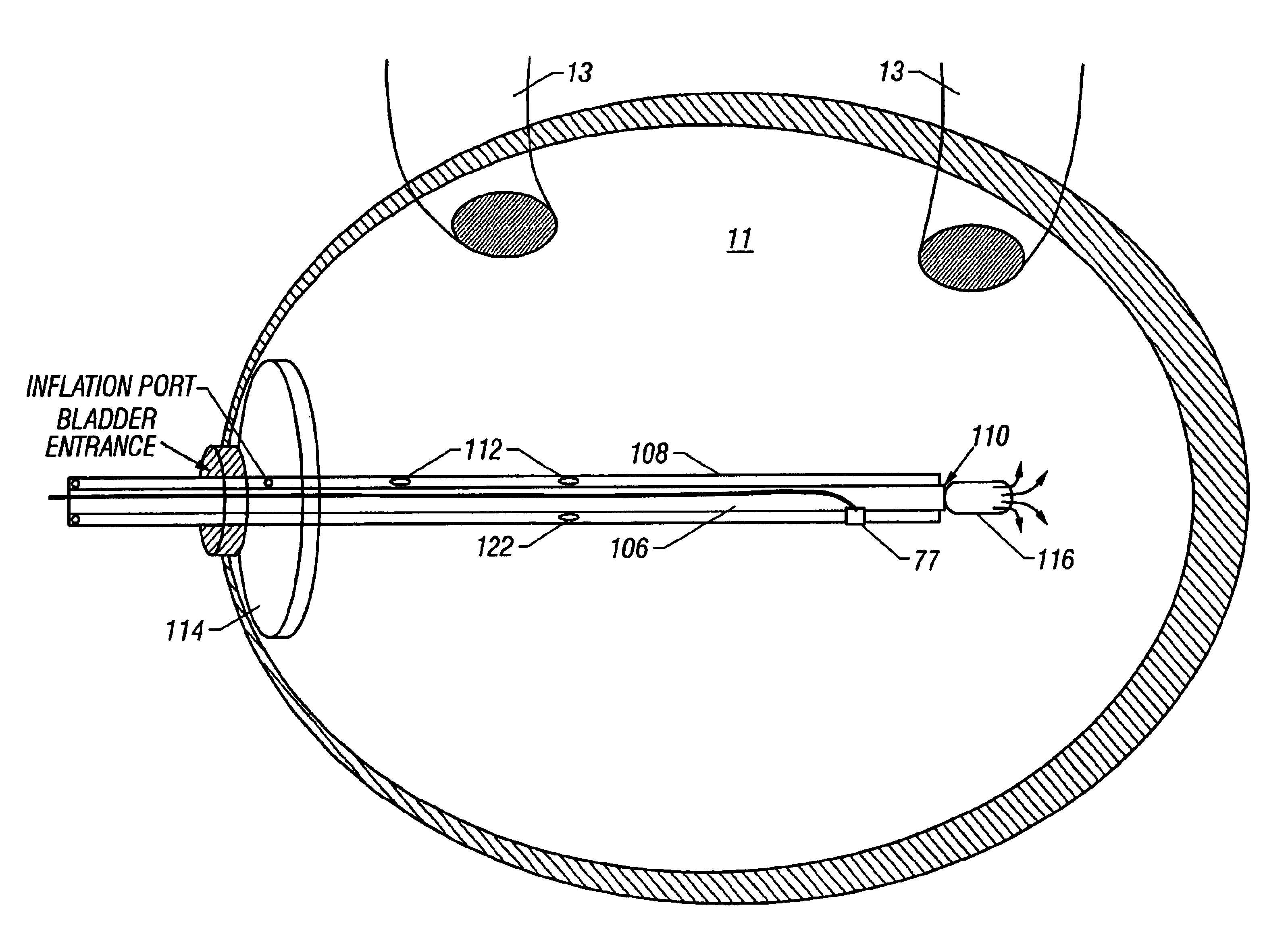 Method and apparatus for regulating patient temperature by irrigating the bladder with a fluid