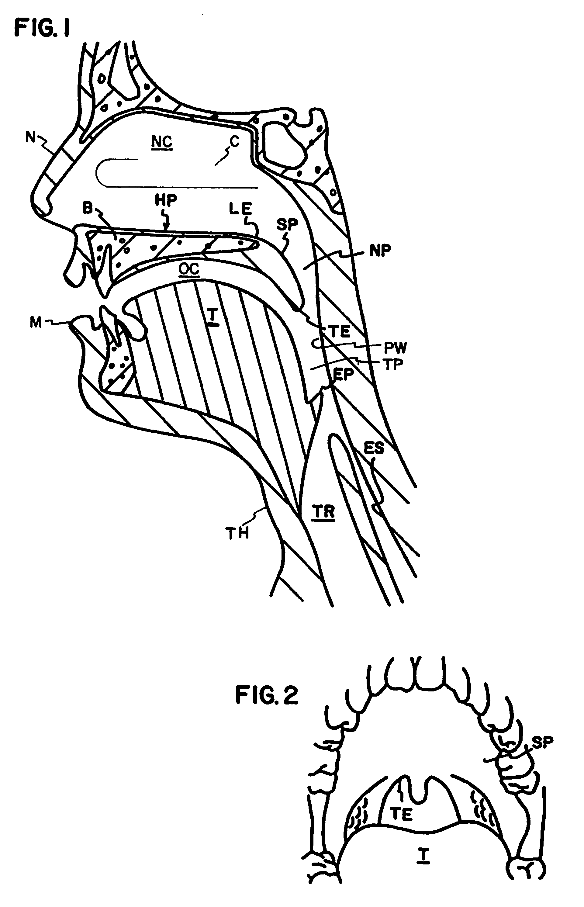 Method and apparatus to treat conditions of the naso-pharyngeal area