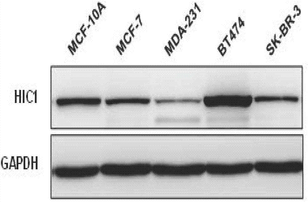 Application of HIC1 (hypermethylated in cancer 1) to diagnosis, treatment, prognosis and recurrence prediction of tumors