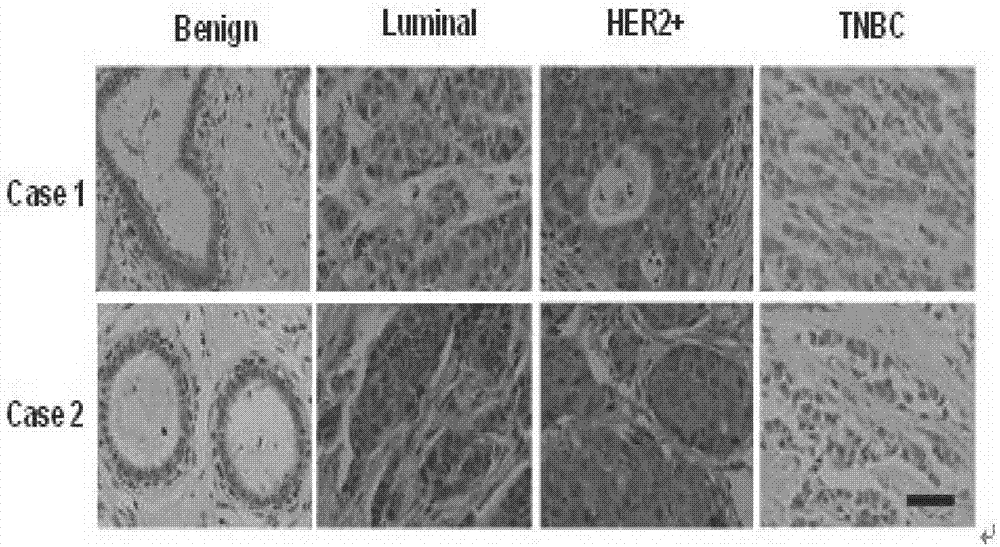 Application of HIC1 (hypermethylated in cancer 1) to diagnosis, treatment, prognosis and recurrence prediction of tumors