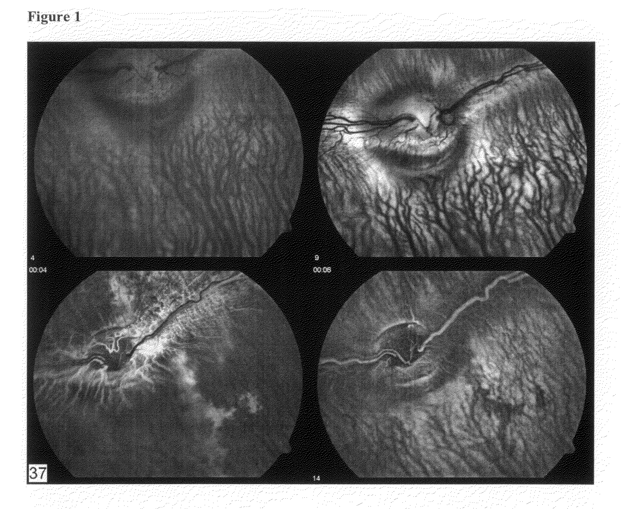 Compositions and methods for treating ophthalmic disorders