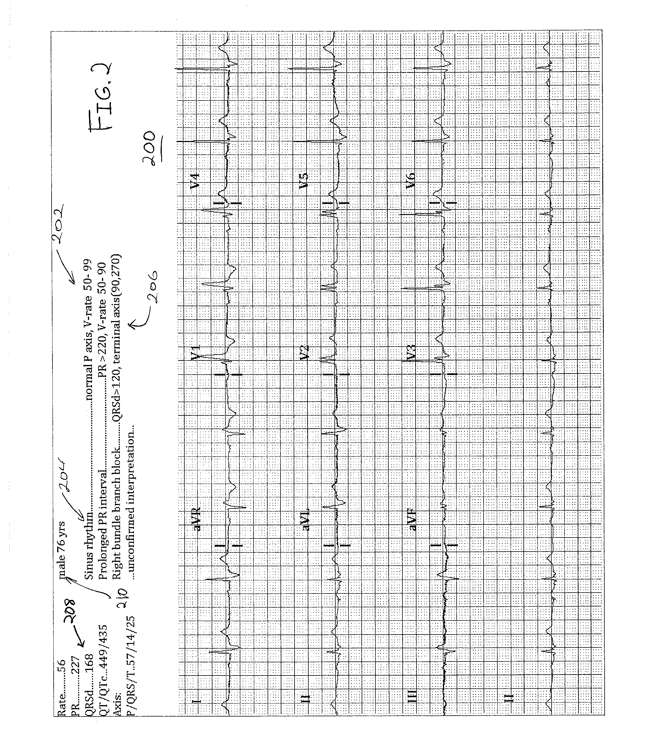 Diagnostic representation and interpretation of ECG leads on a digital display