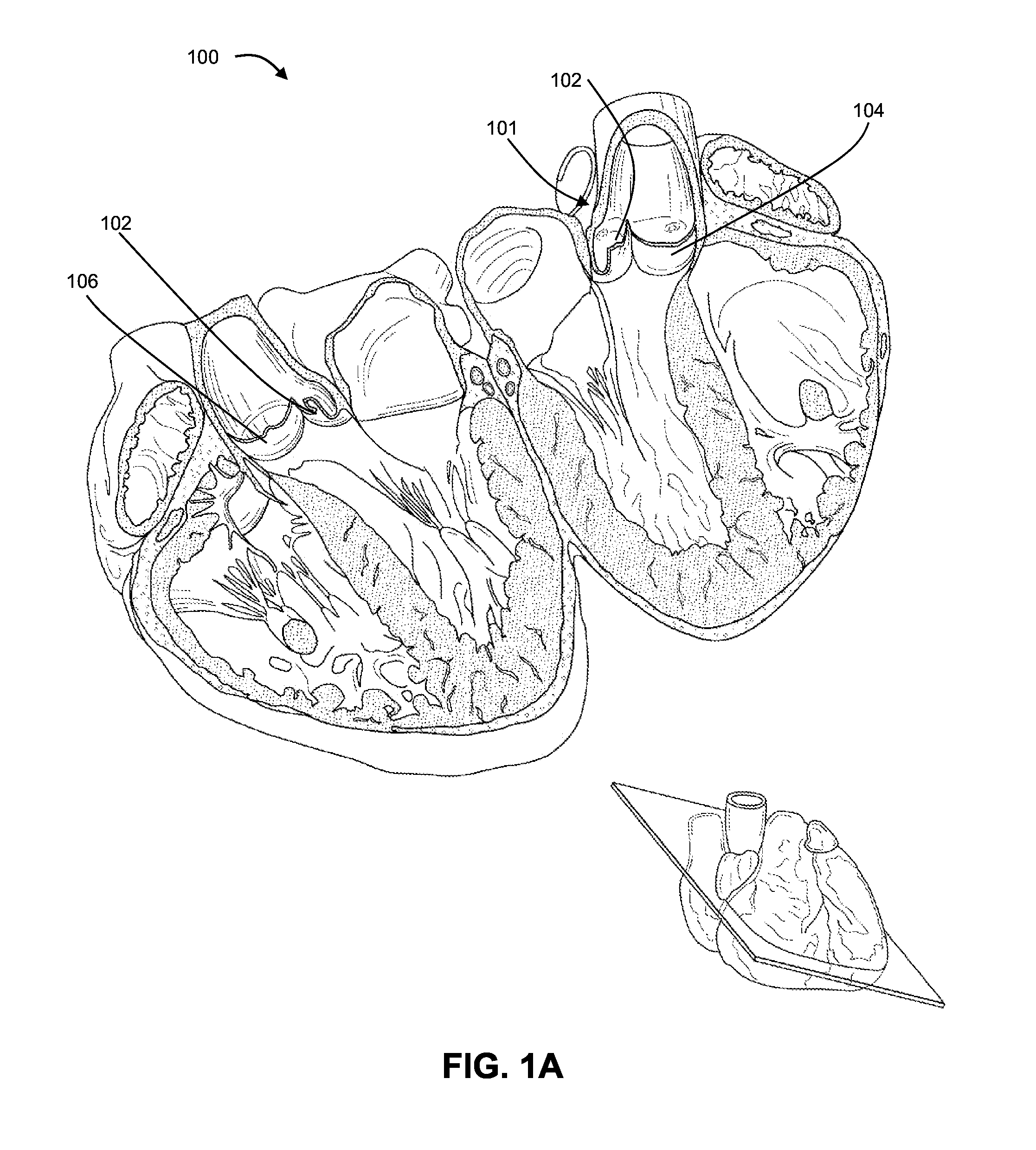 Shockwave valvuloplasty with multiple balloons