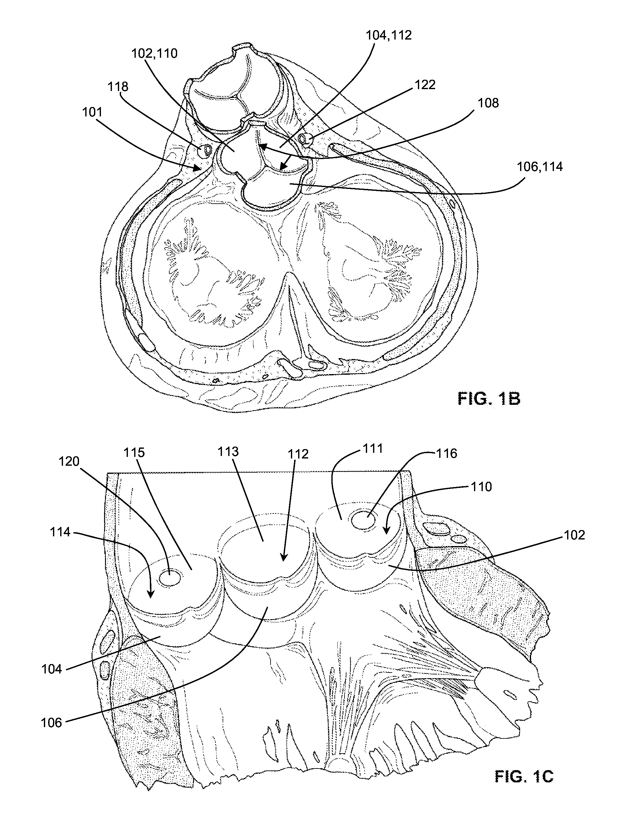 Shockwave valvuloplasty with multiple balloons