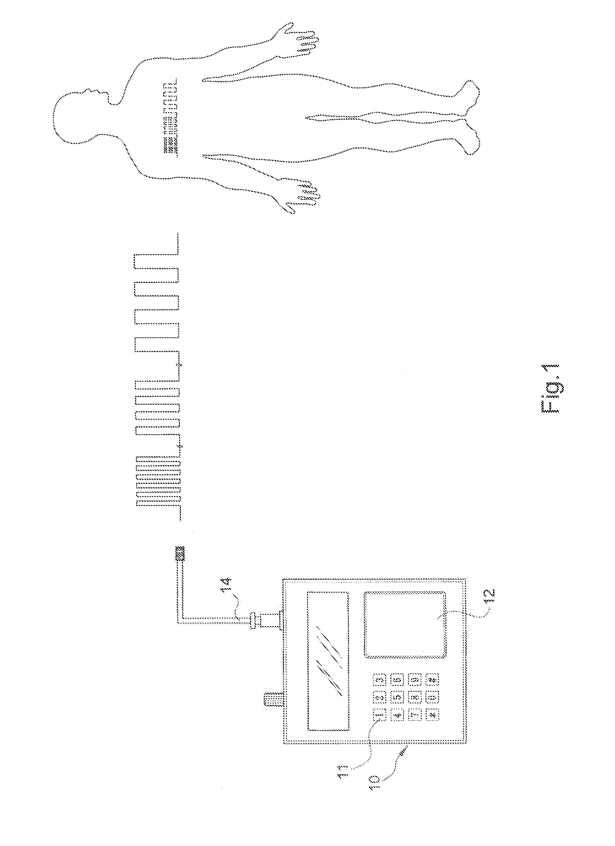 Diabetes glucagon mitigation system and method with an electrical energy wave generator