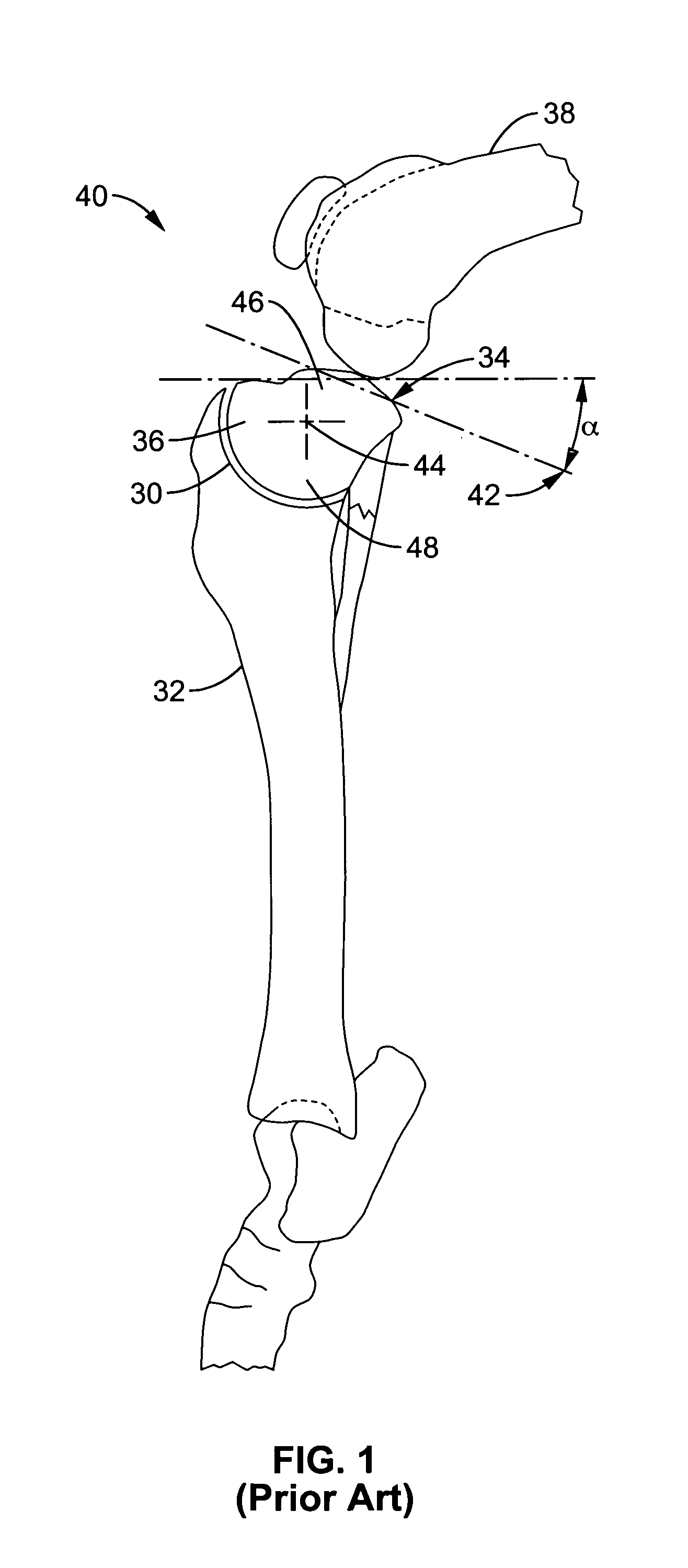 Apparatus and methods for tibial plateau leveling osteotomy