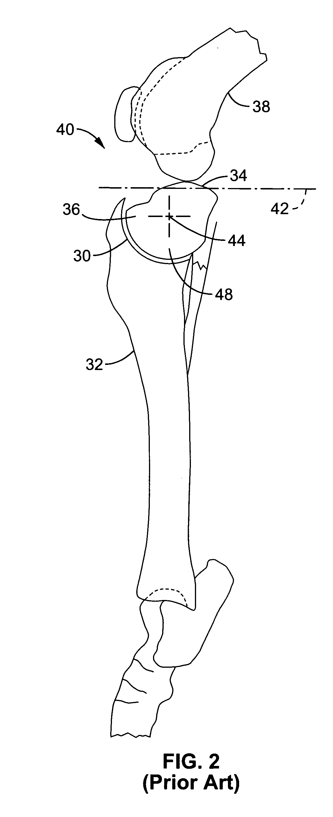 Apparatus and methods for tibial plateau leveling osteotomy