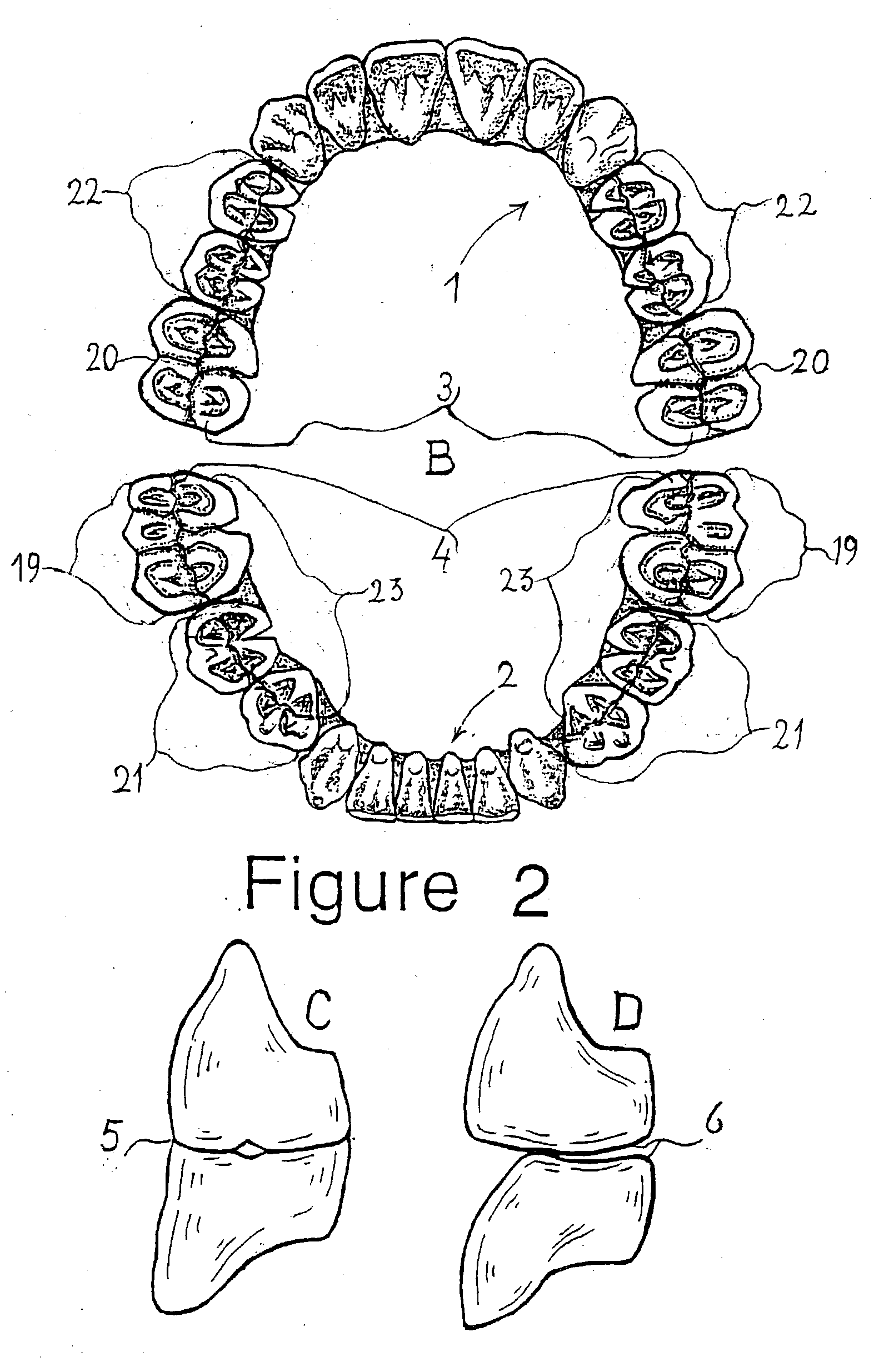 Combination set of denture teeth units for setting-up dentures in balanced articulation