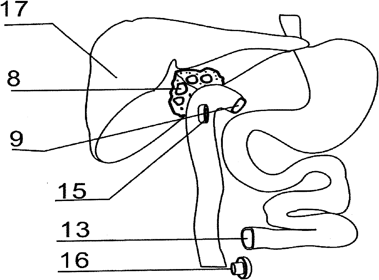 Hepaticojejunostomic and intestinal end-to-side anastomotic magnetic device