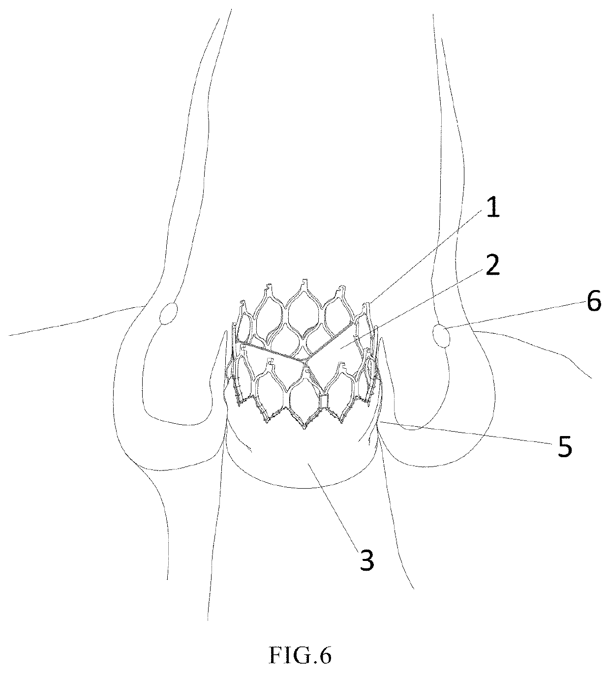 Valved stent and heart valve with same