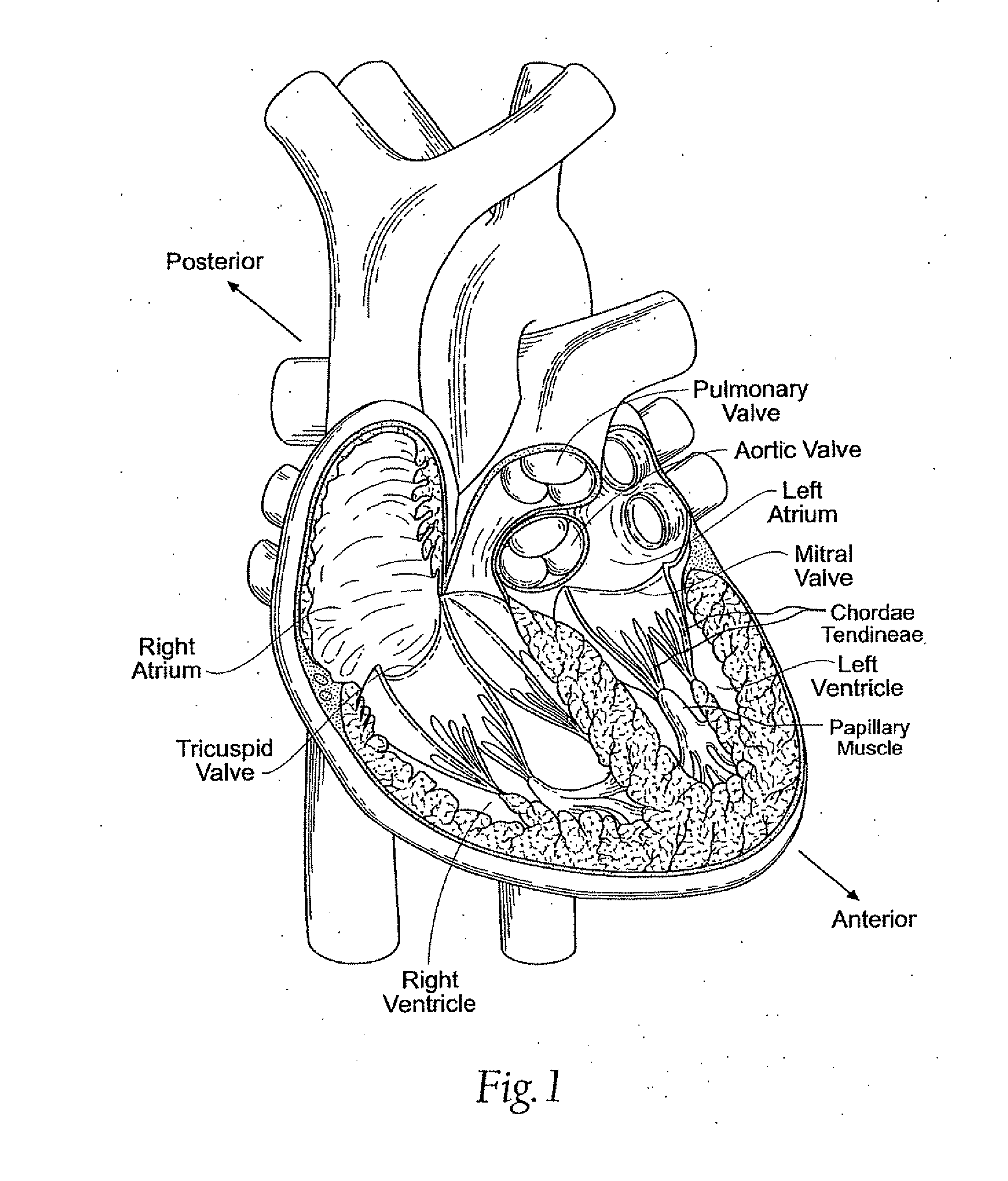 Quick-Release Annuloplasty Ring Holder