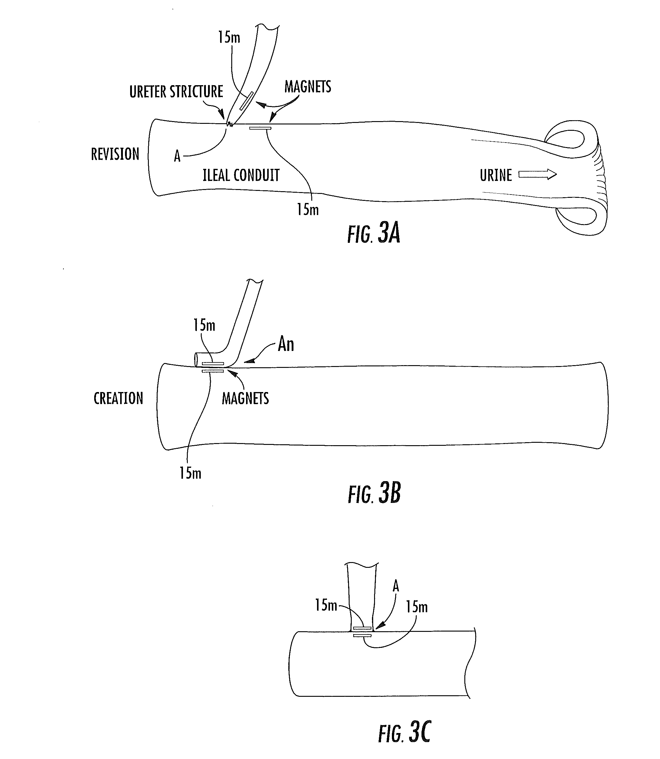 Ureter to ileal conduit anastomosis using magnetic compression and related delivery devices and methods