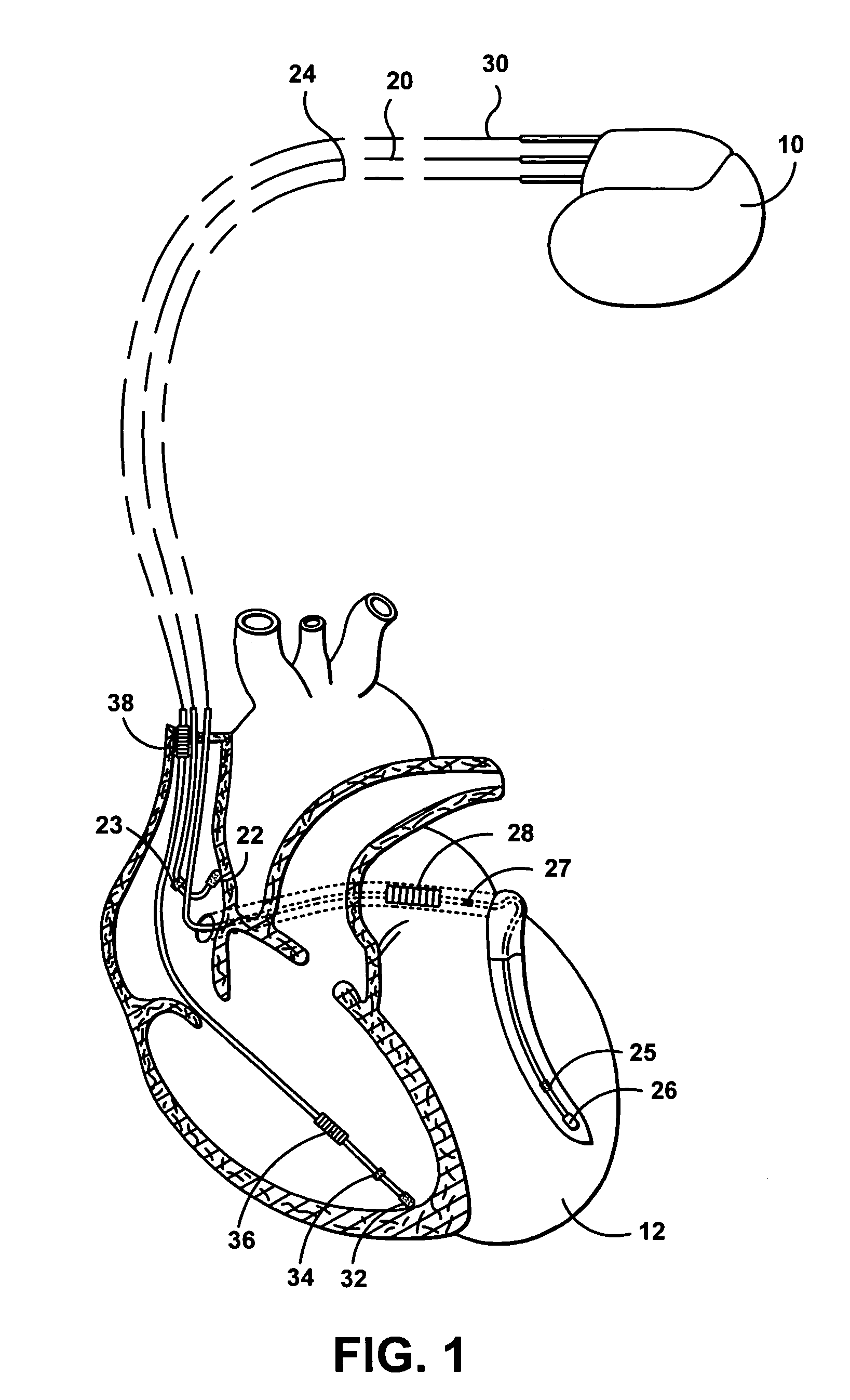 Multi-chamber ventricular automatic capture method and apparatus for minimizing true and blanking period induced ventricular undersensing