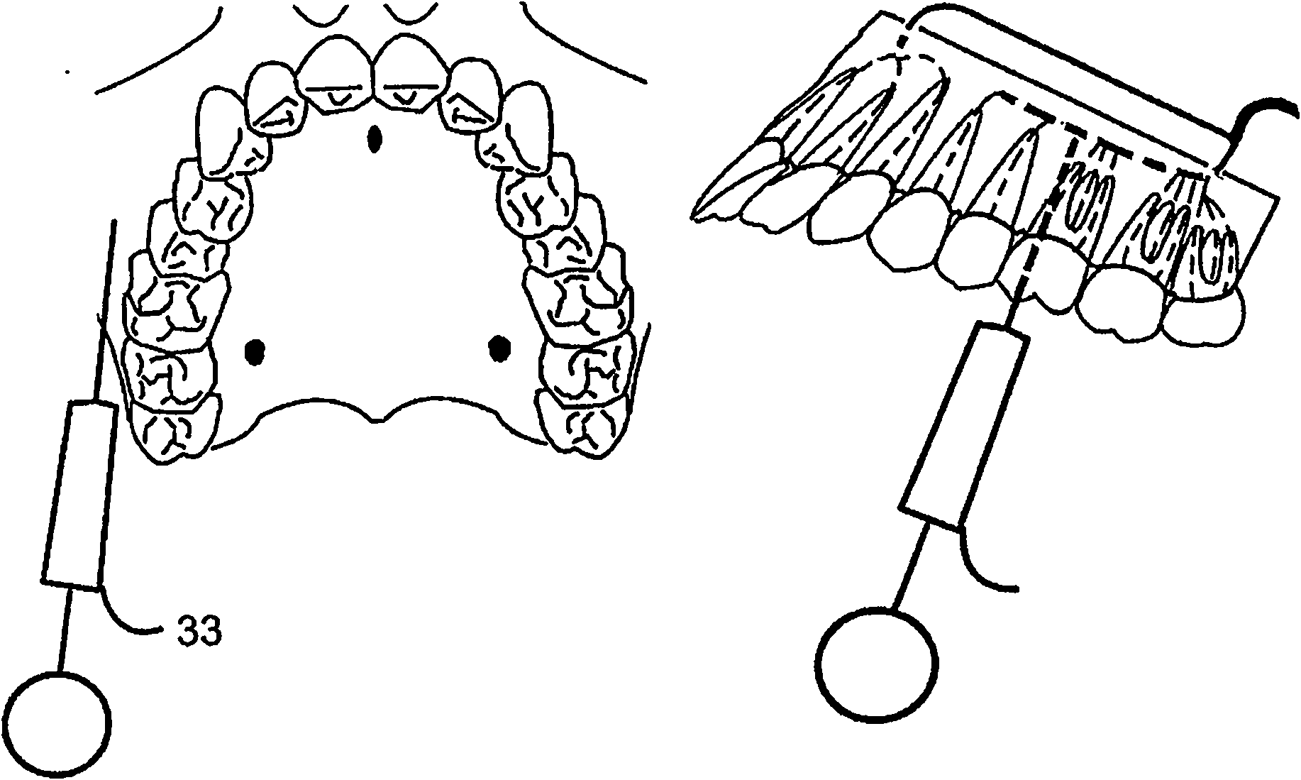 A method and a device for practicing dental treatments