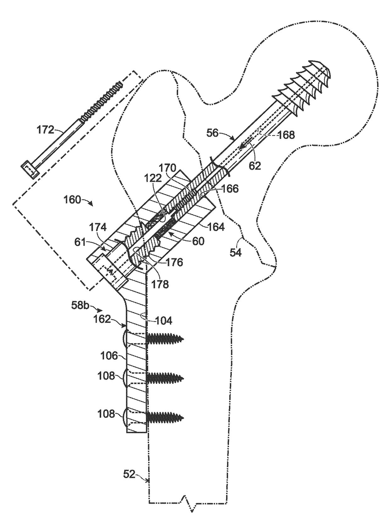 Hip fixation with load-controlled dynamization