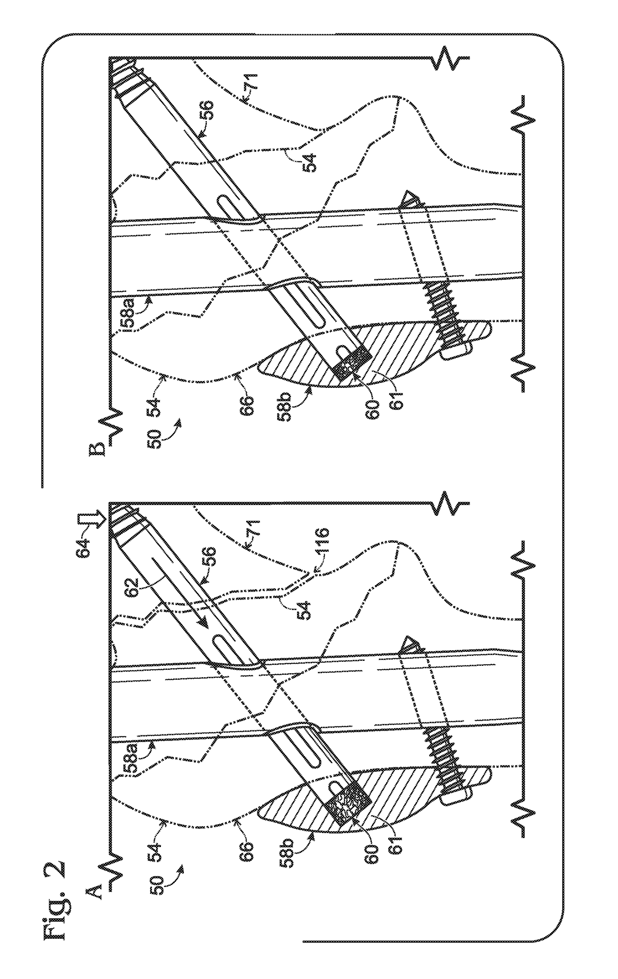 Hip fixation with load-controlled dynamization