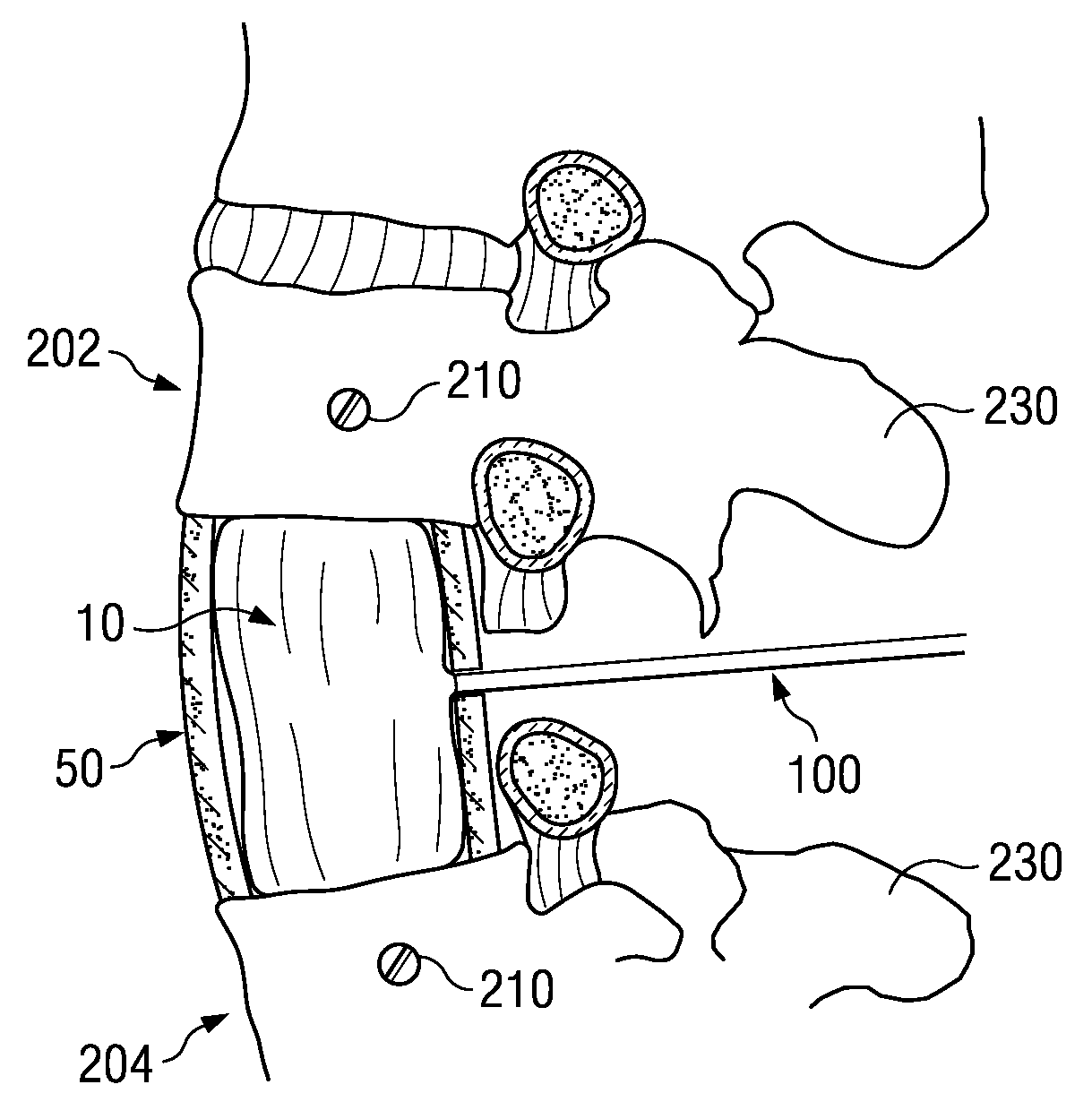 Formed in place corpectomy device