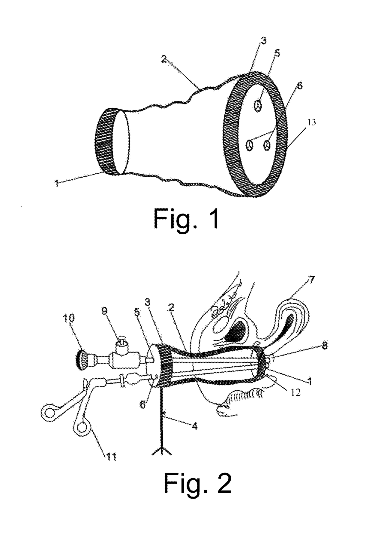 Full-vagina sleeve cylindrical expansion and pneumoperitoneum integrated device