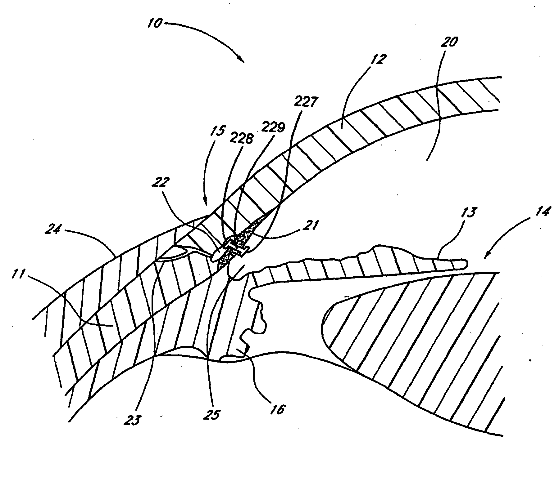 Devices and methods for glaucoma treatment