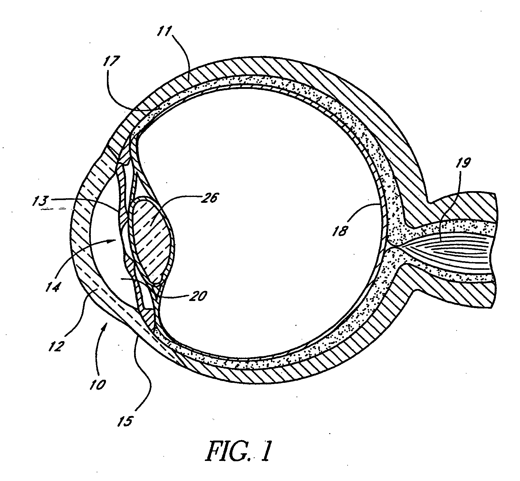 Devices and methods for glaucoma treatment