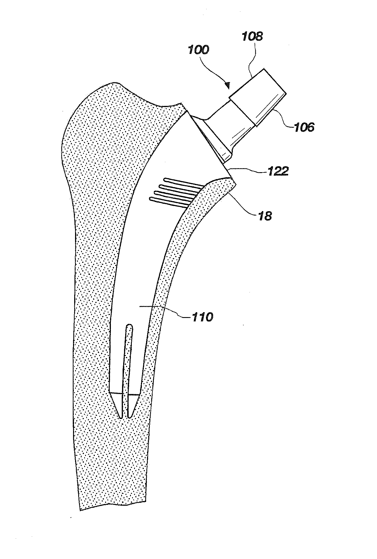 Tissue sparing implant