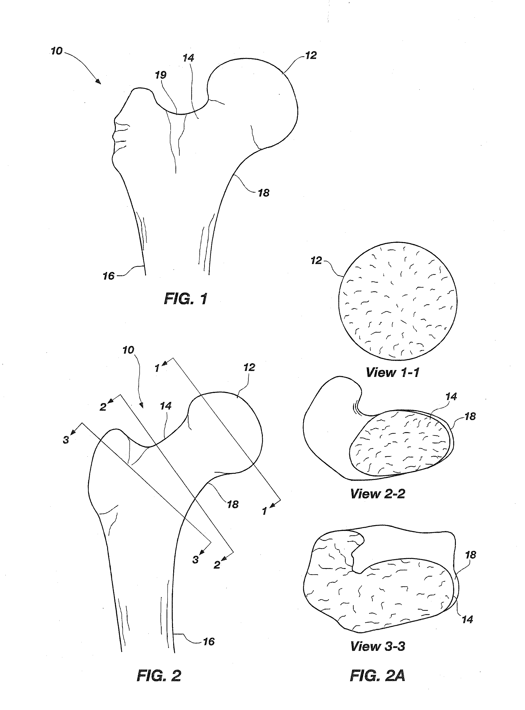 Tissue sparing implant