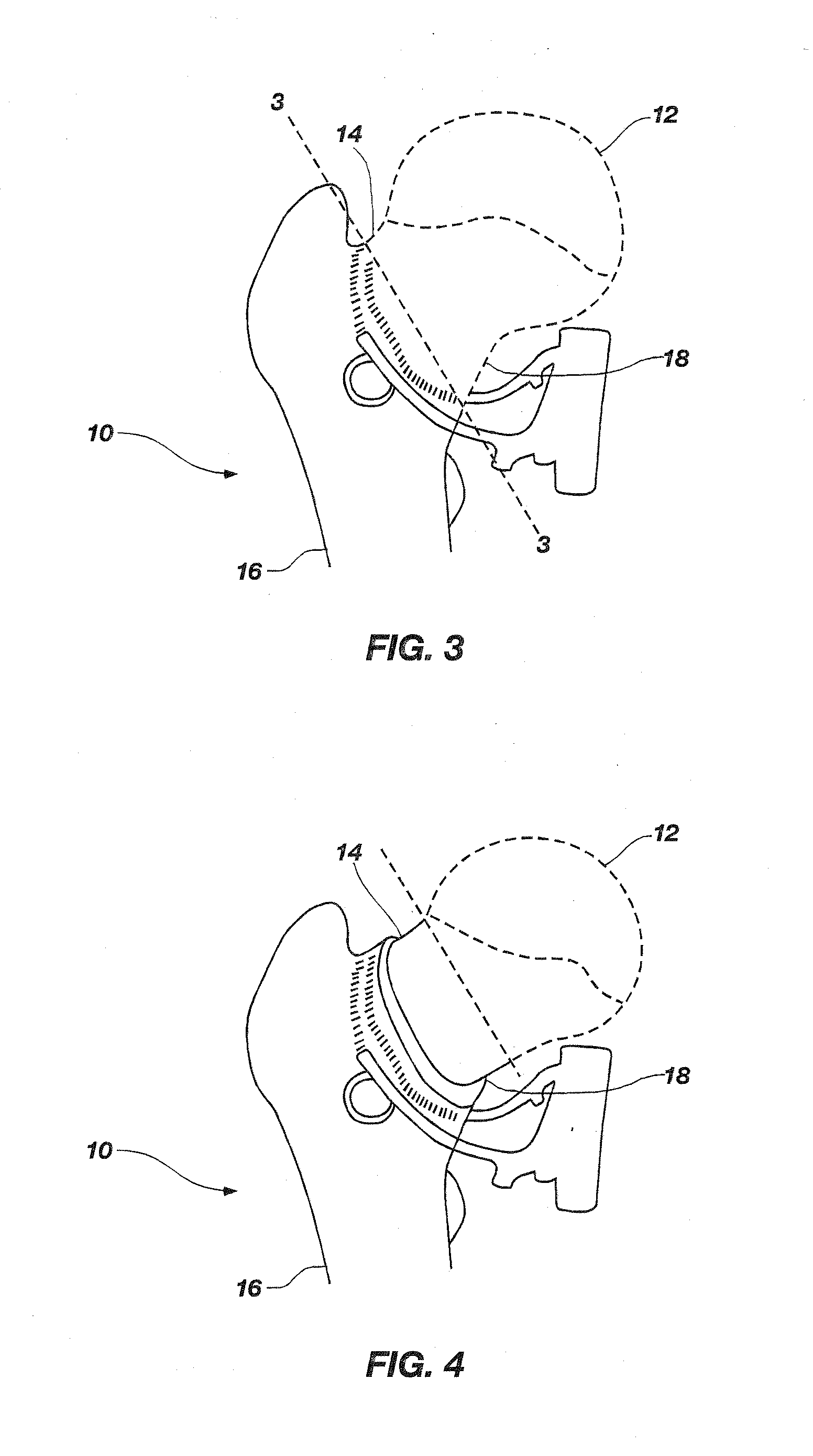 Tissue sparing implant