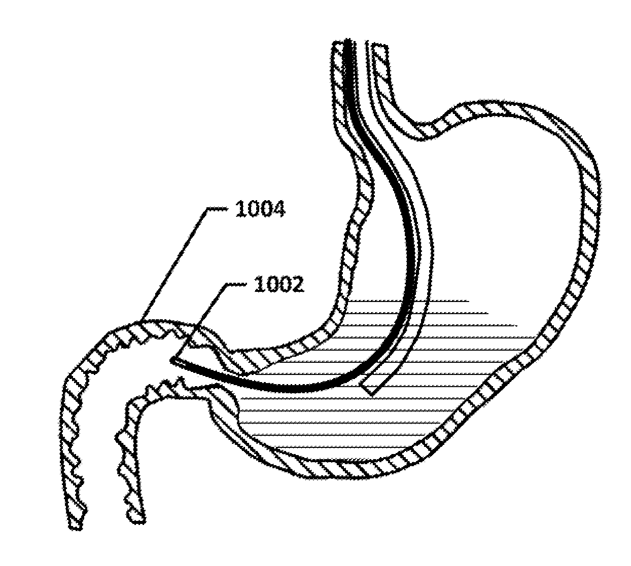 Devices and methods to measure gastric residual volume