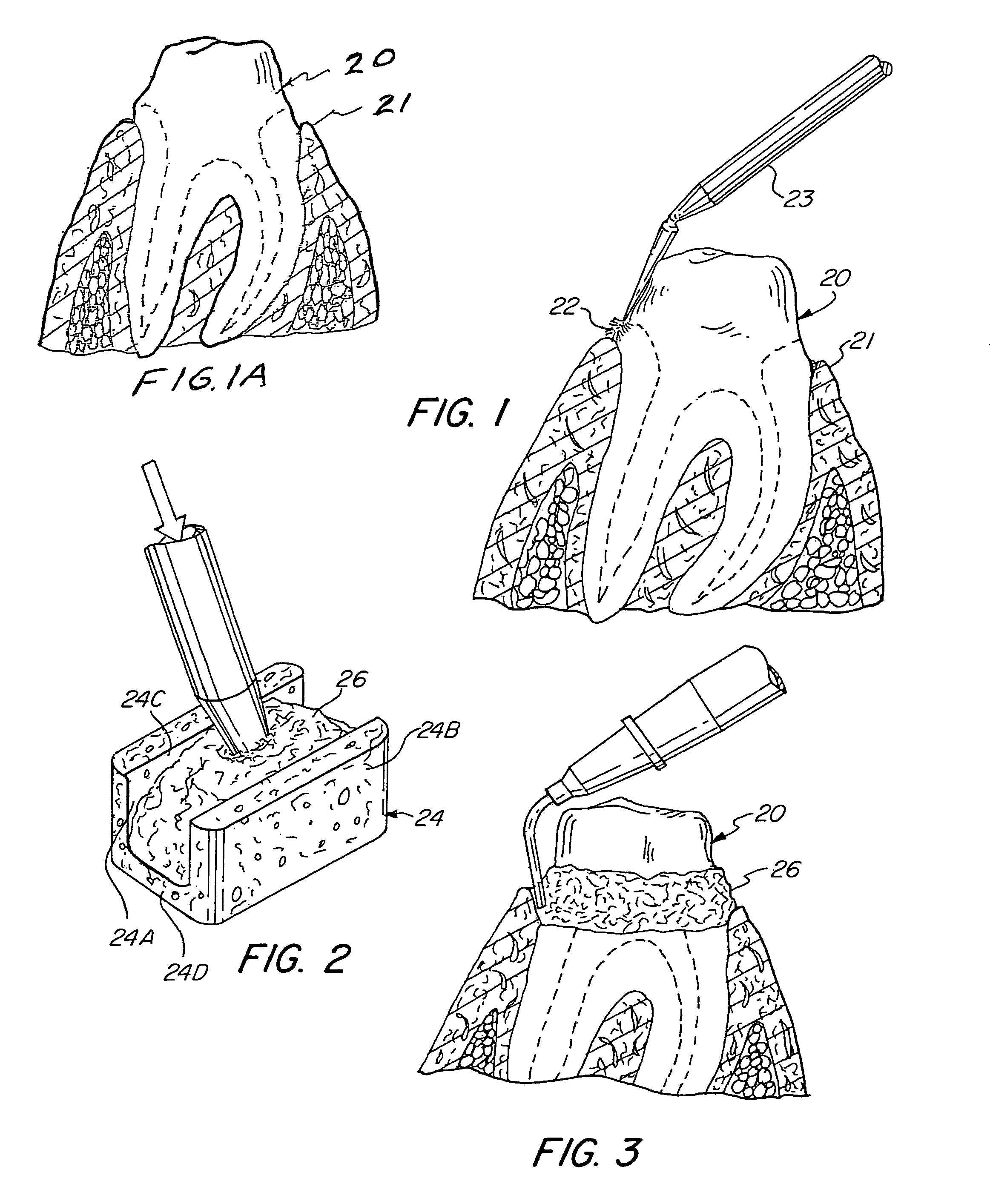 Gingival tissue retraction device and method