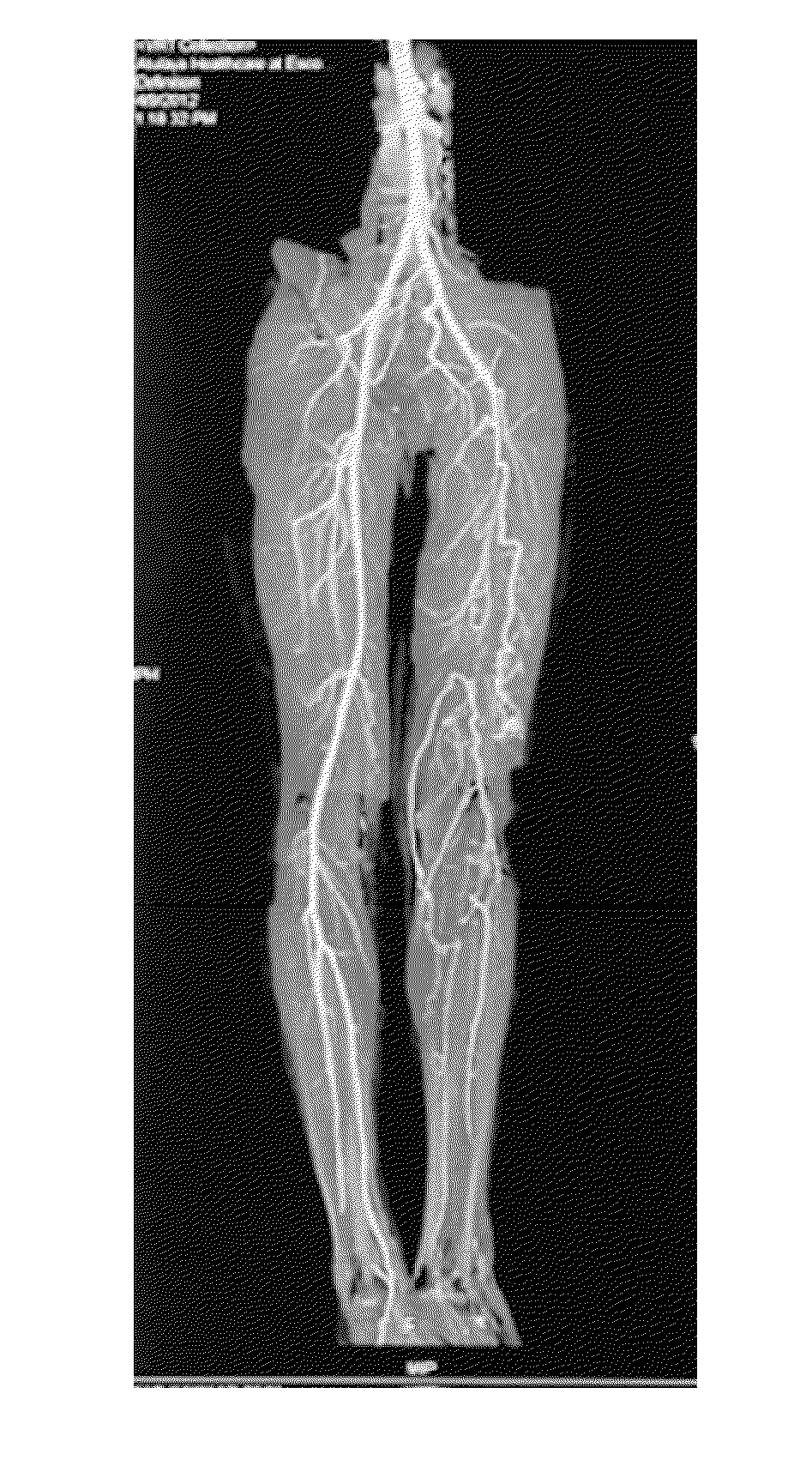 Rapid infusion of autologous bone marrow derived stem cells