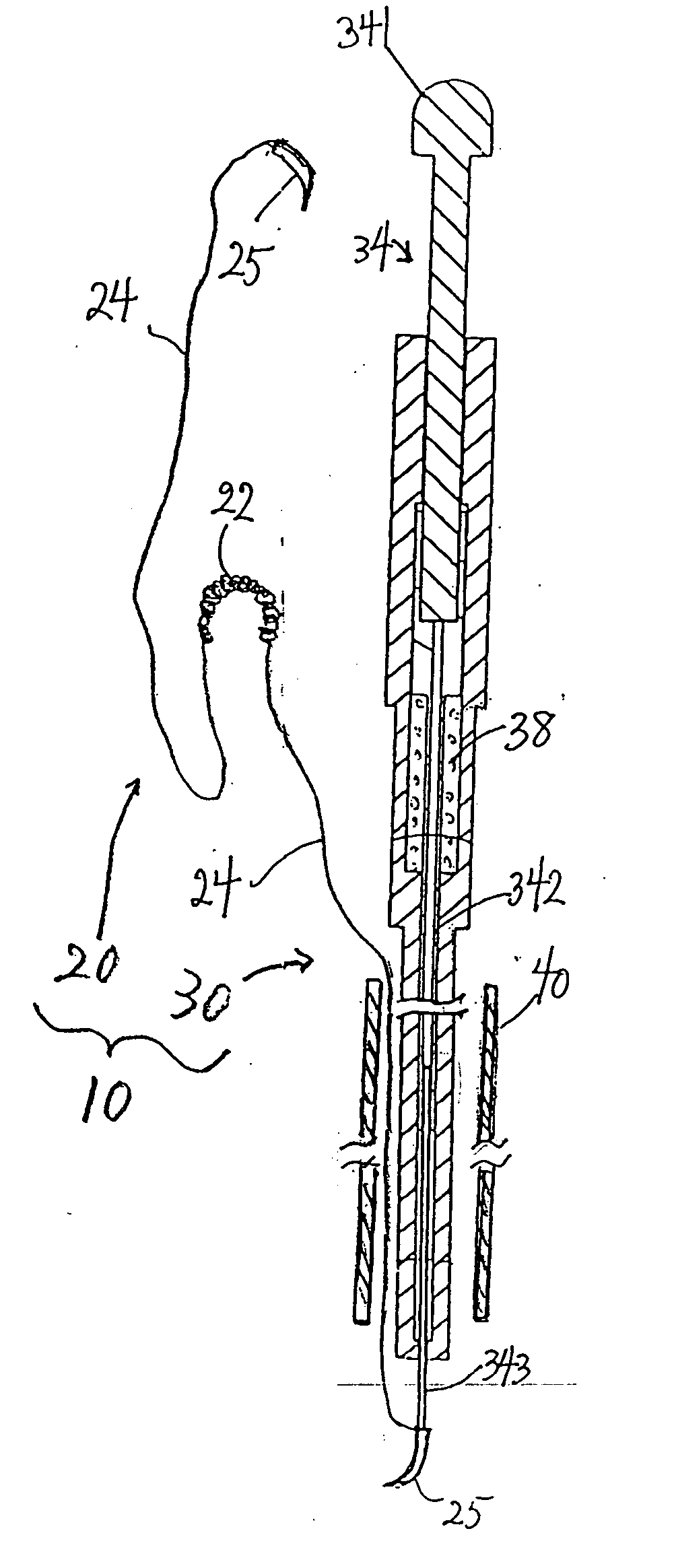 Minimally invasive valve repair procedure and apparatus