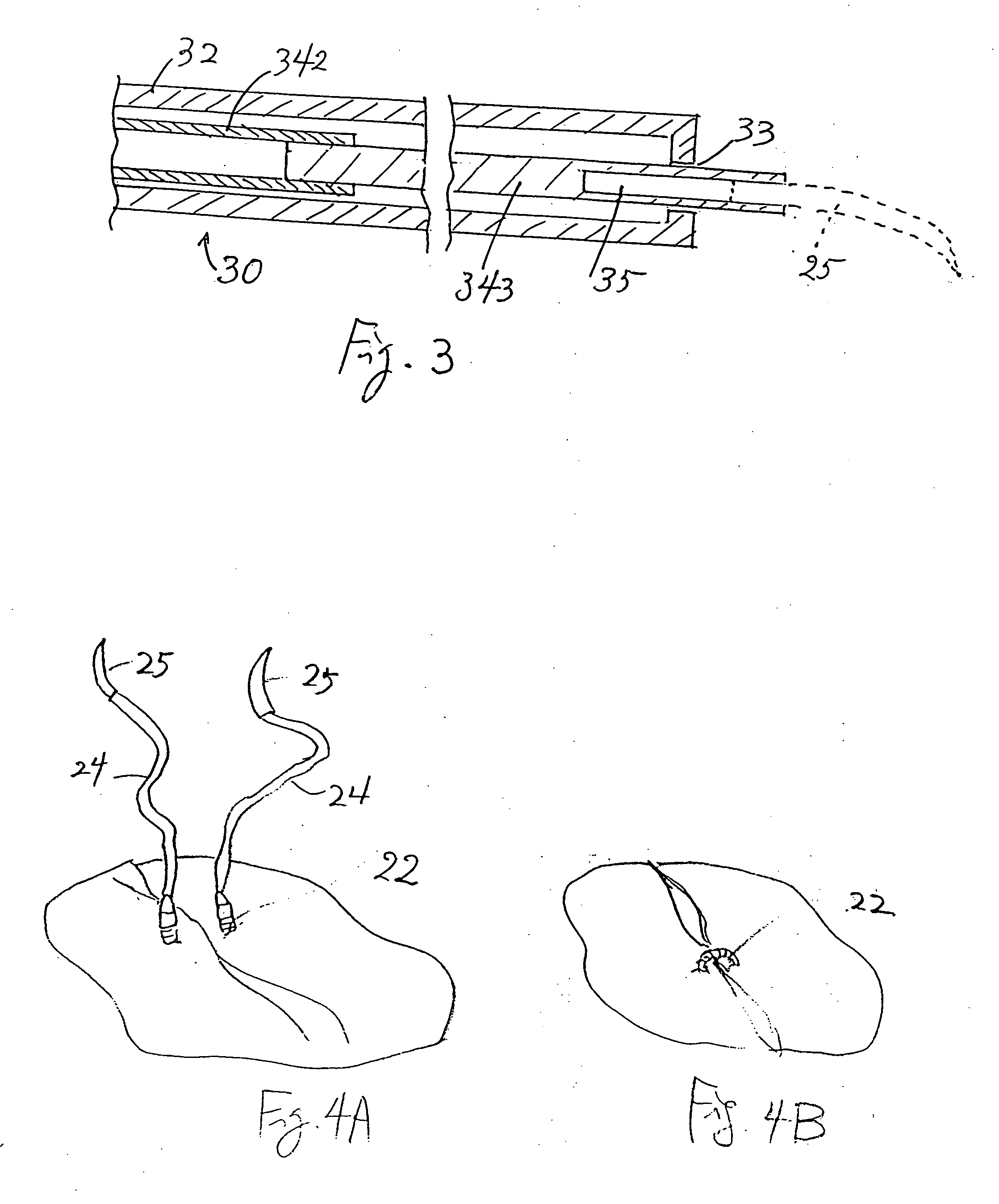 Minimally invasive valve repair procedure and apparatus