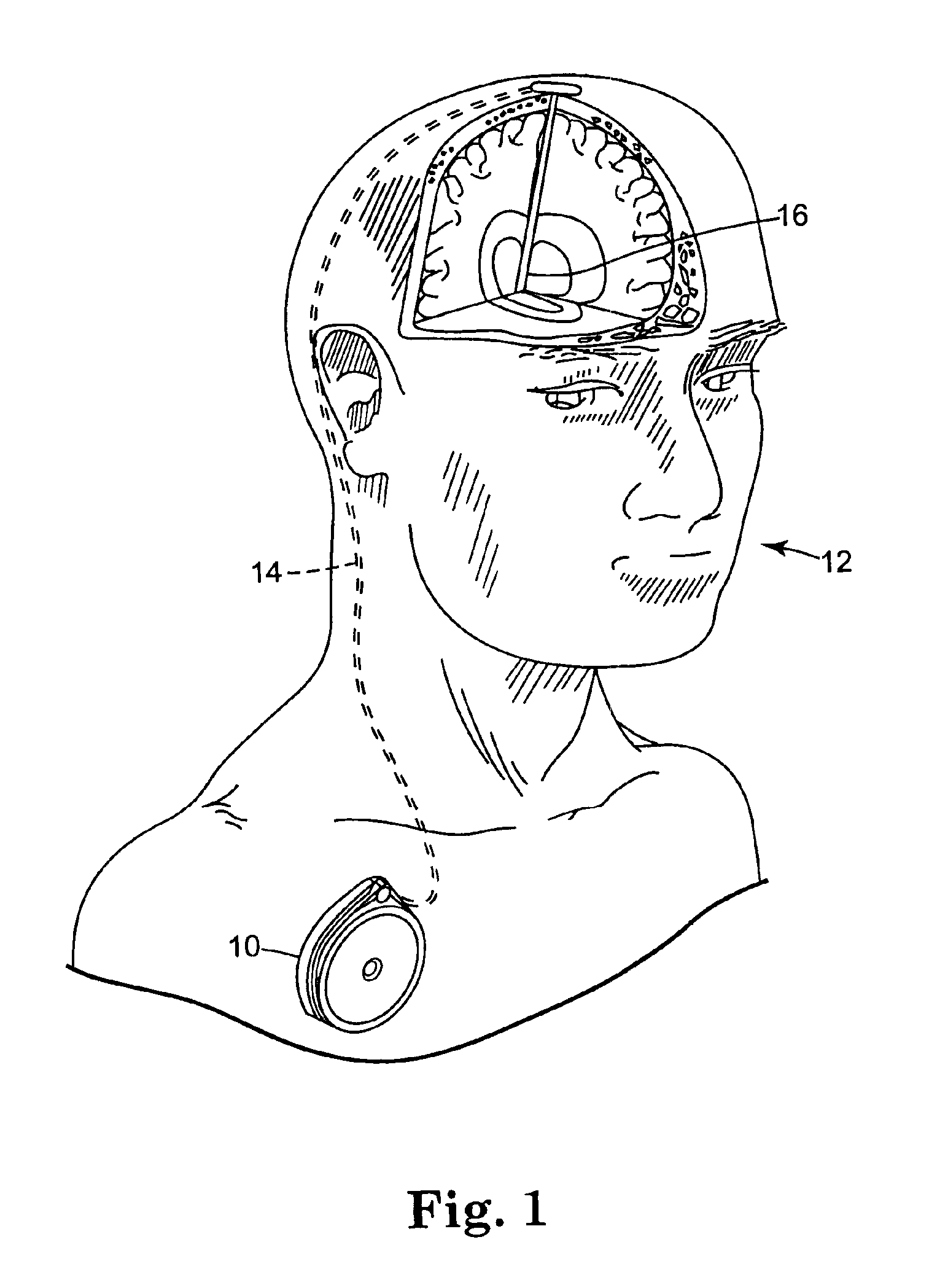 System and method for monitoring power source longevity of an implantable medical device