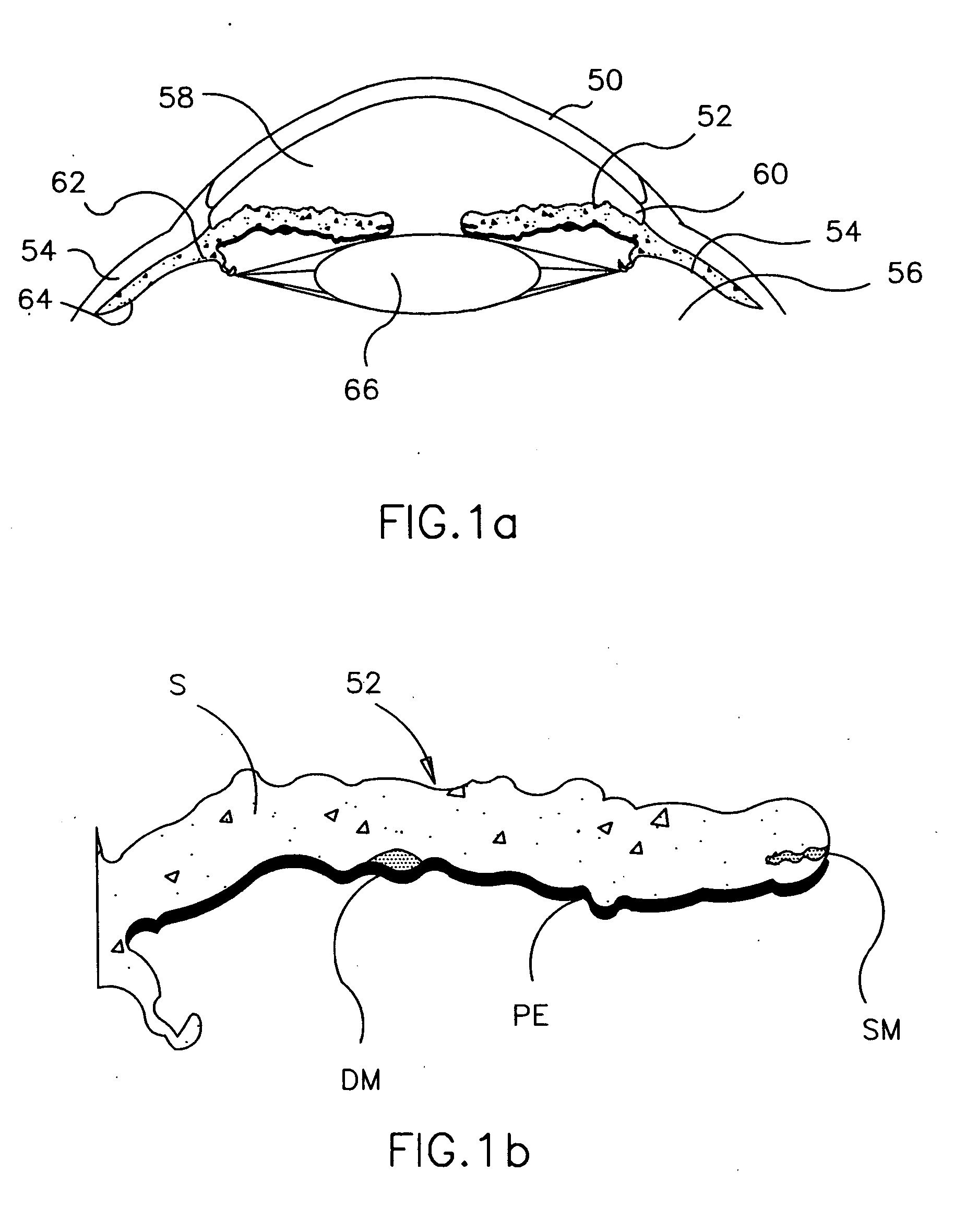 Refractive intraocular implant lens and method