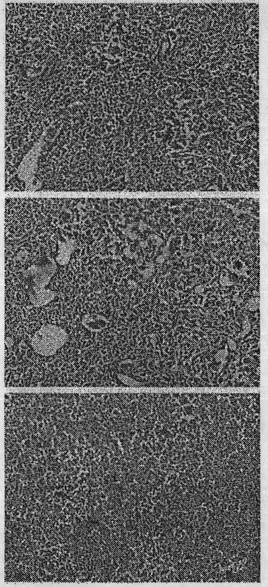 Gene medicine for inhibiting lung cancer metastasis and pulmonary metastases