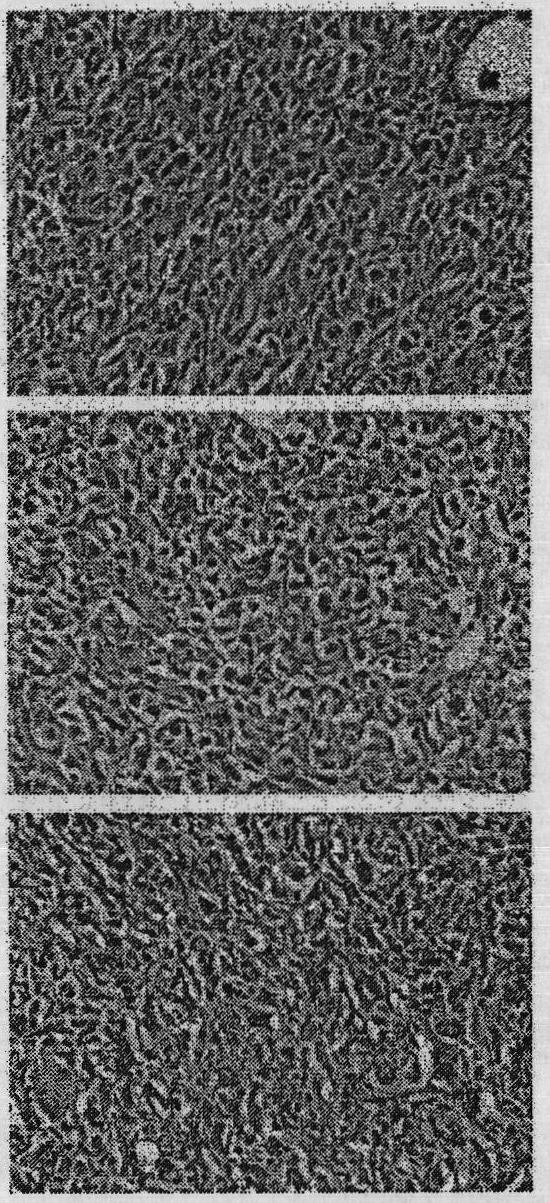 Gene medicine for inhibiting lung cancer metastasis and pulmonary metastases