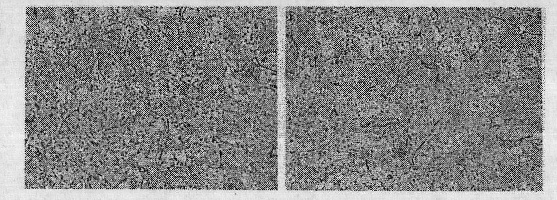 Gene medicine for inhibiting lung cancer metastasis and pulmonary metastases