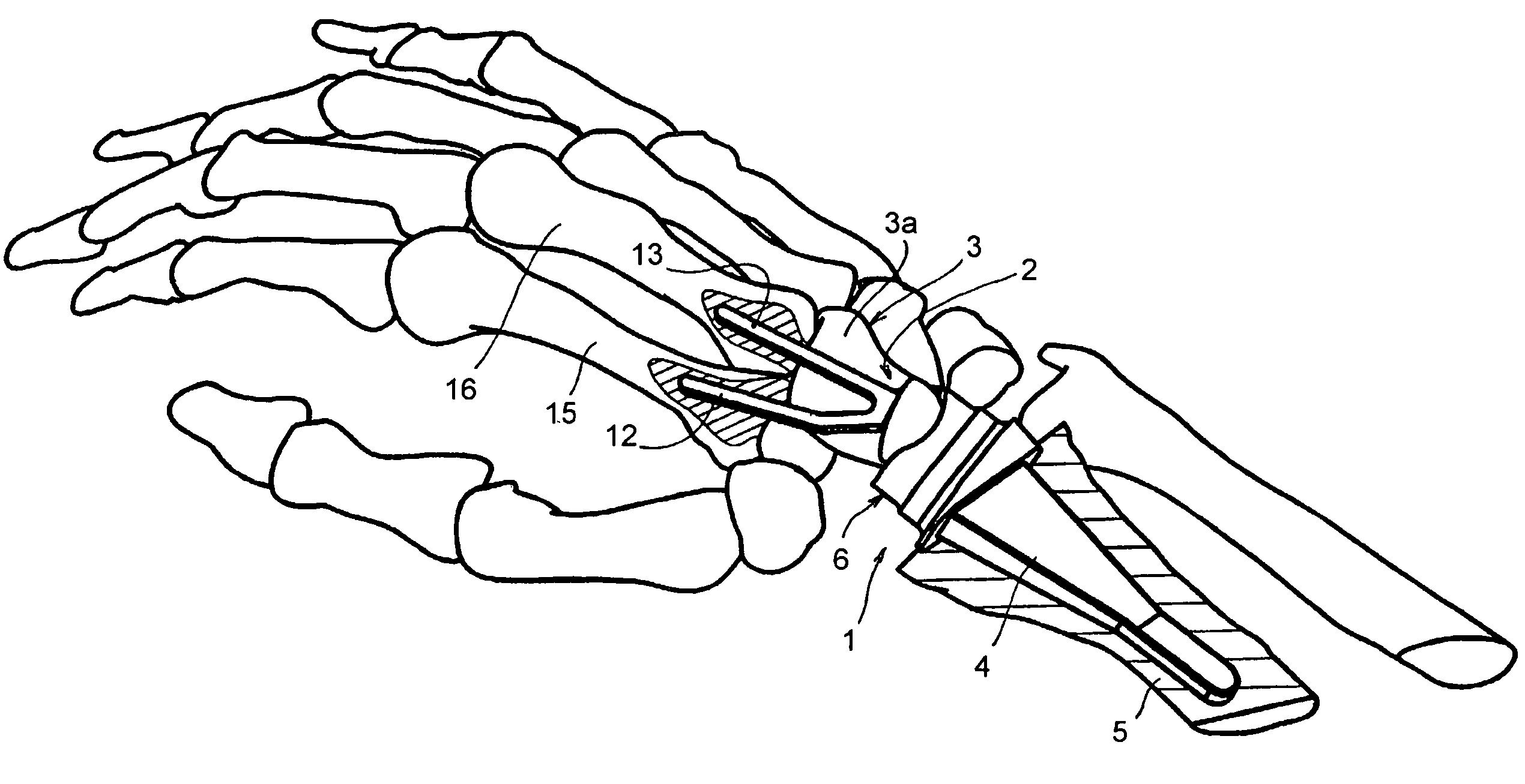 Wrist articulation prosthesis and set of elements allowing building of this prosthesis