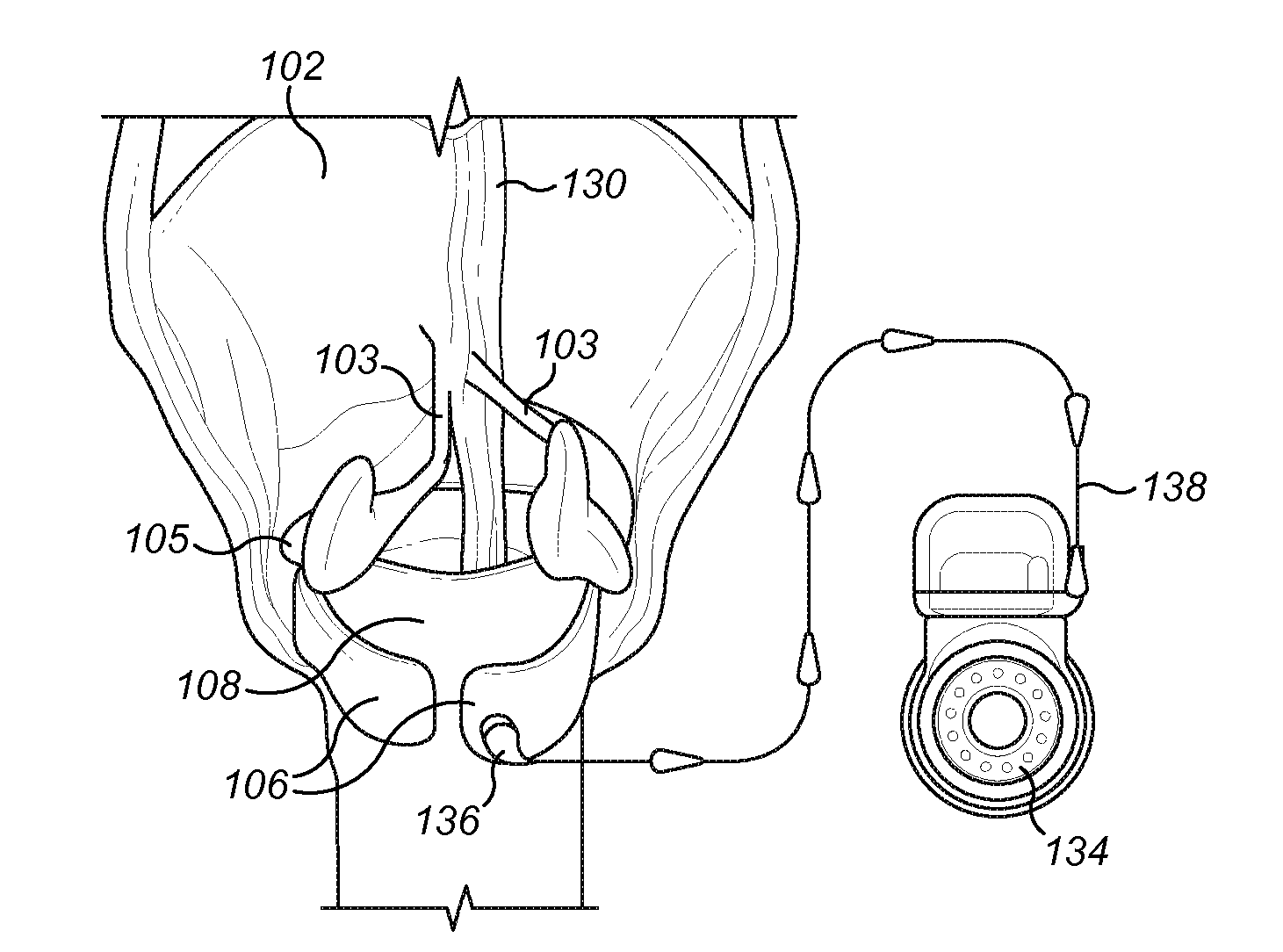 Respiration Sensors for Recording of Triggered Respiratory Signals in Neurostimulators