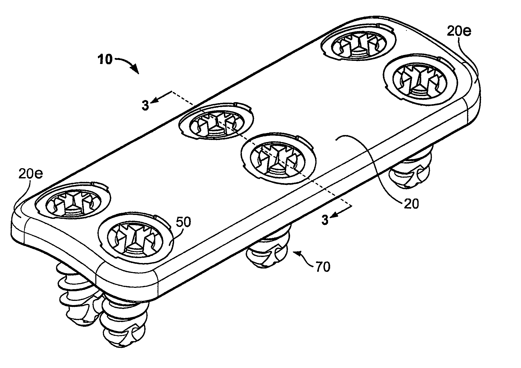 Bone Plate System