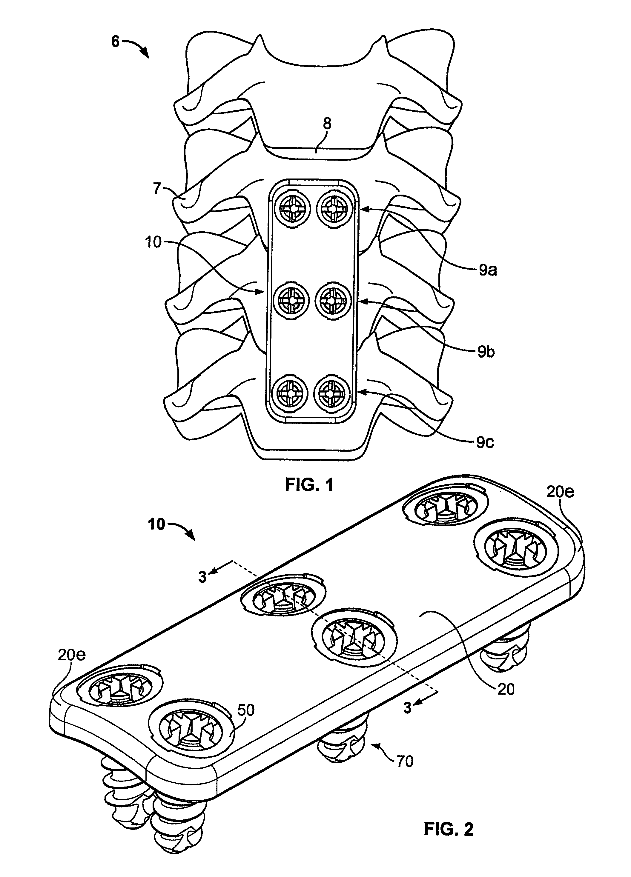 Bone Plate System