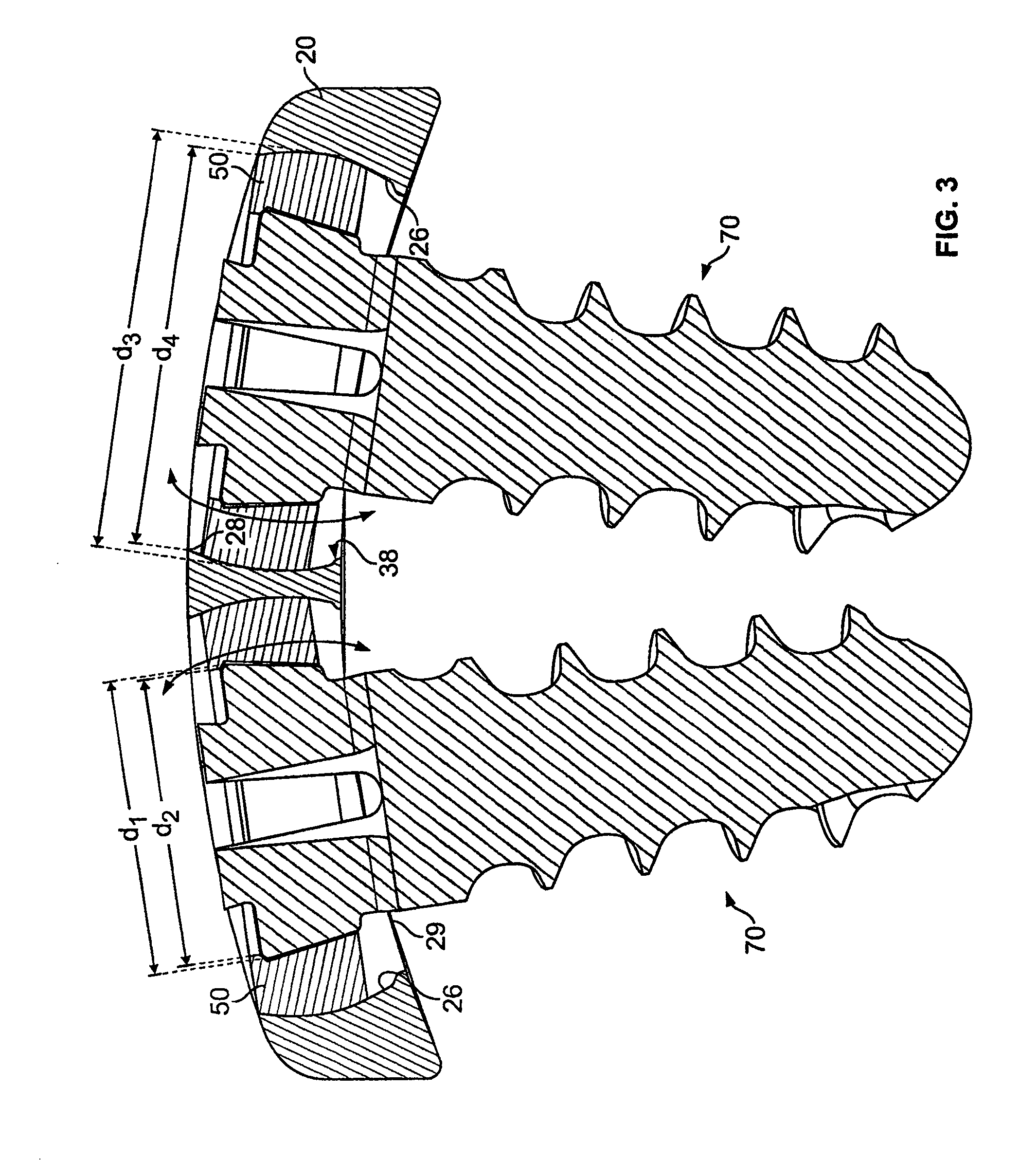 Bone Plate System