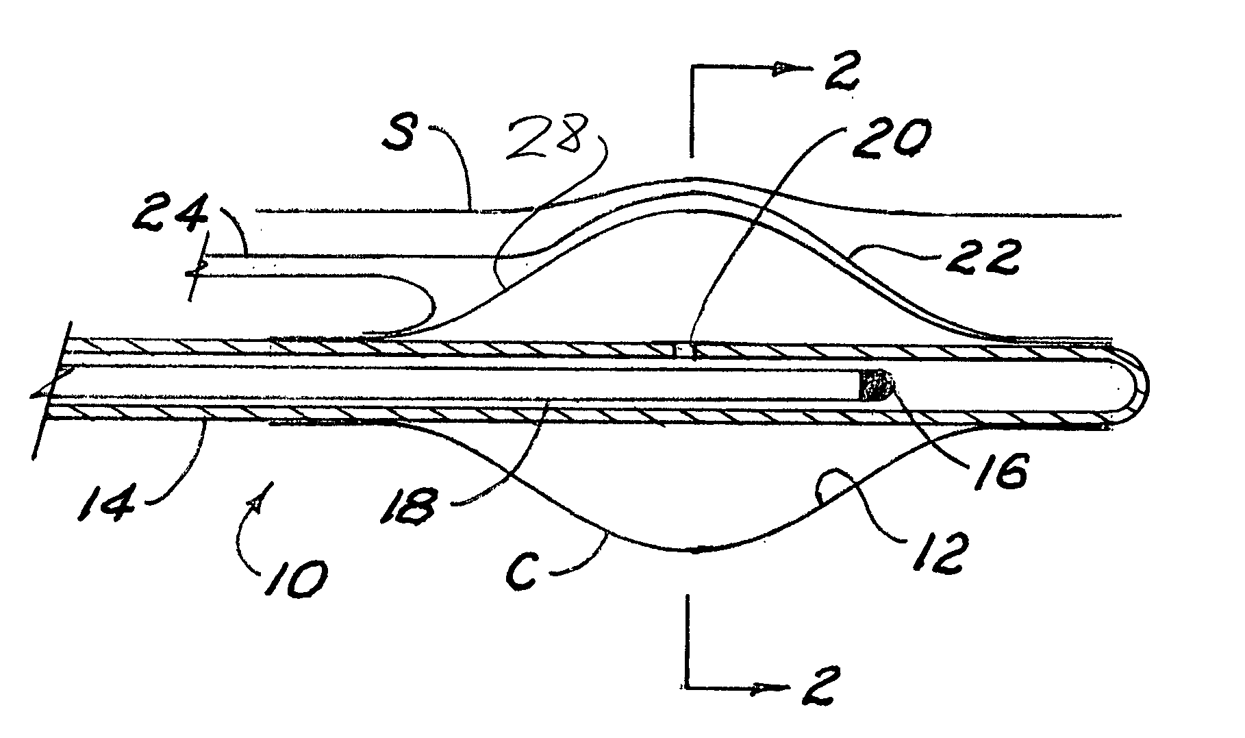 Method and apparatus for modifying distance from a brachytherapy radiation source to sensitive anatomical structures