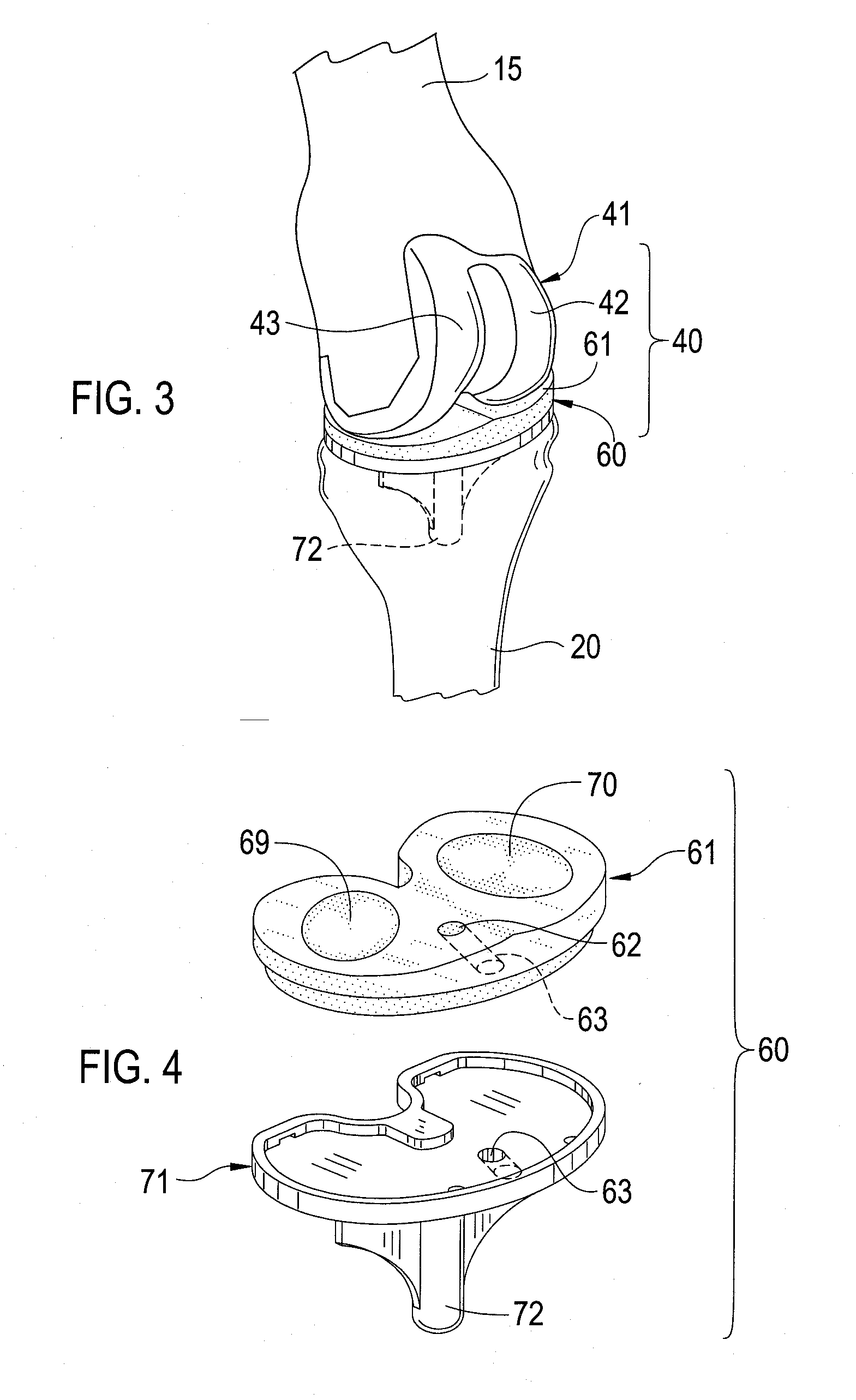 Total Knee Prosthesis and Method for Total Knee Arthroplasty