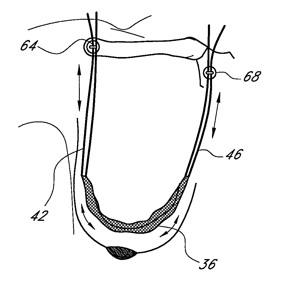 Nonaugmentive mastopexy