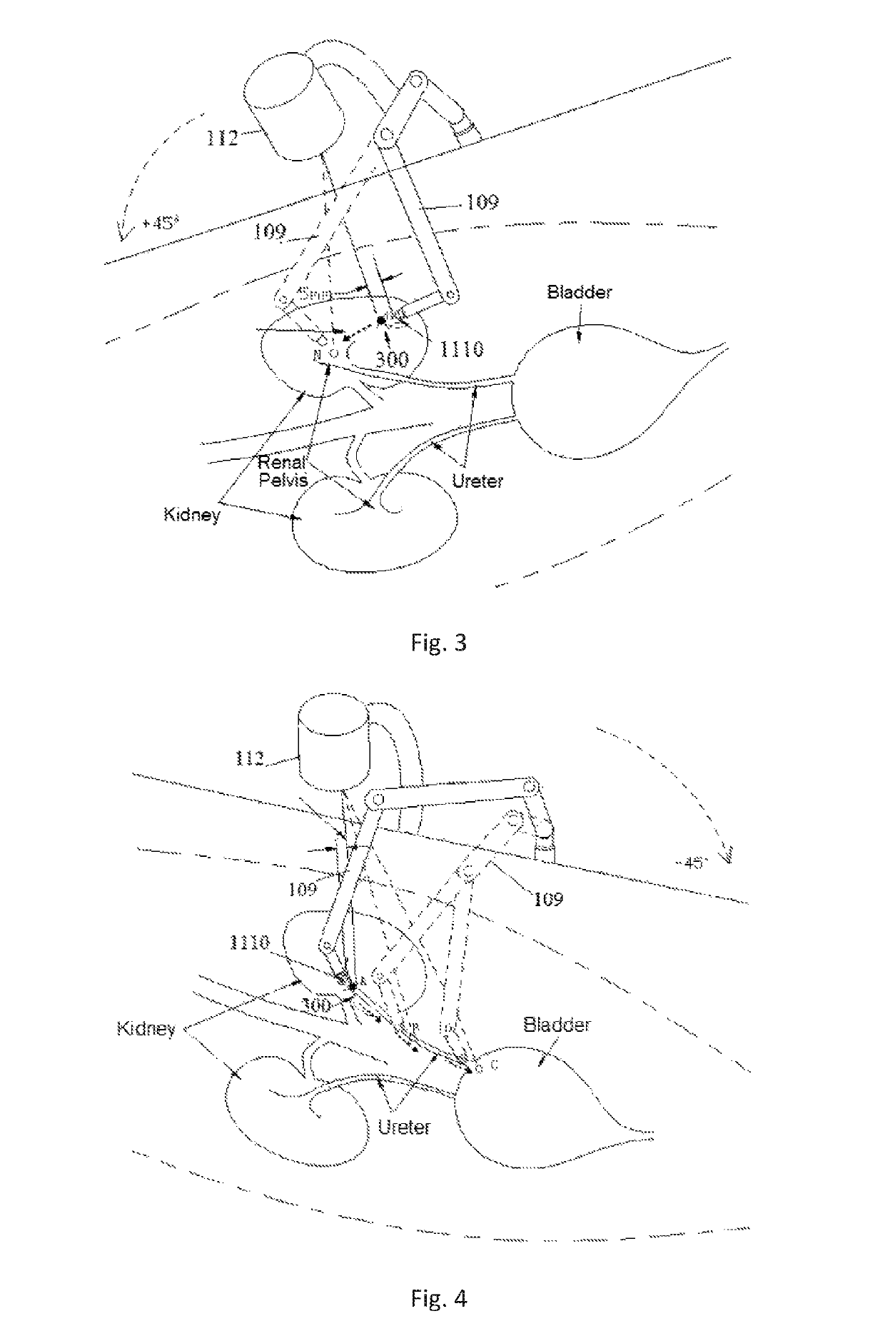 Apparatus for removing calculus in vitro