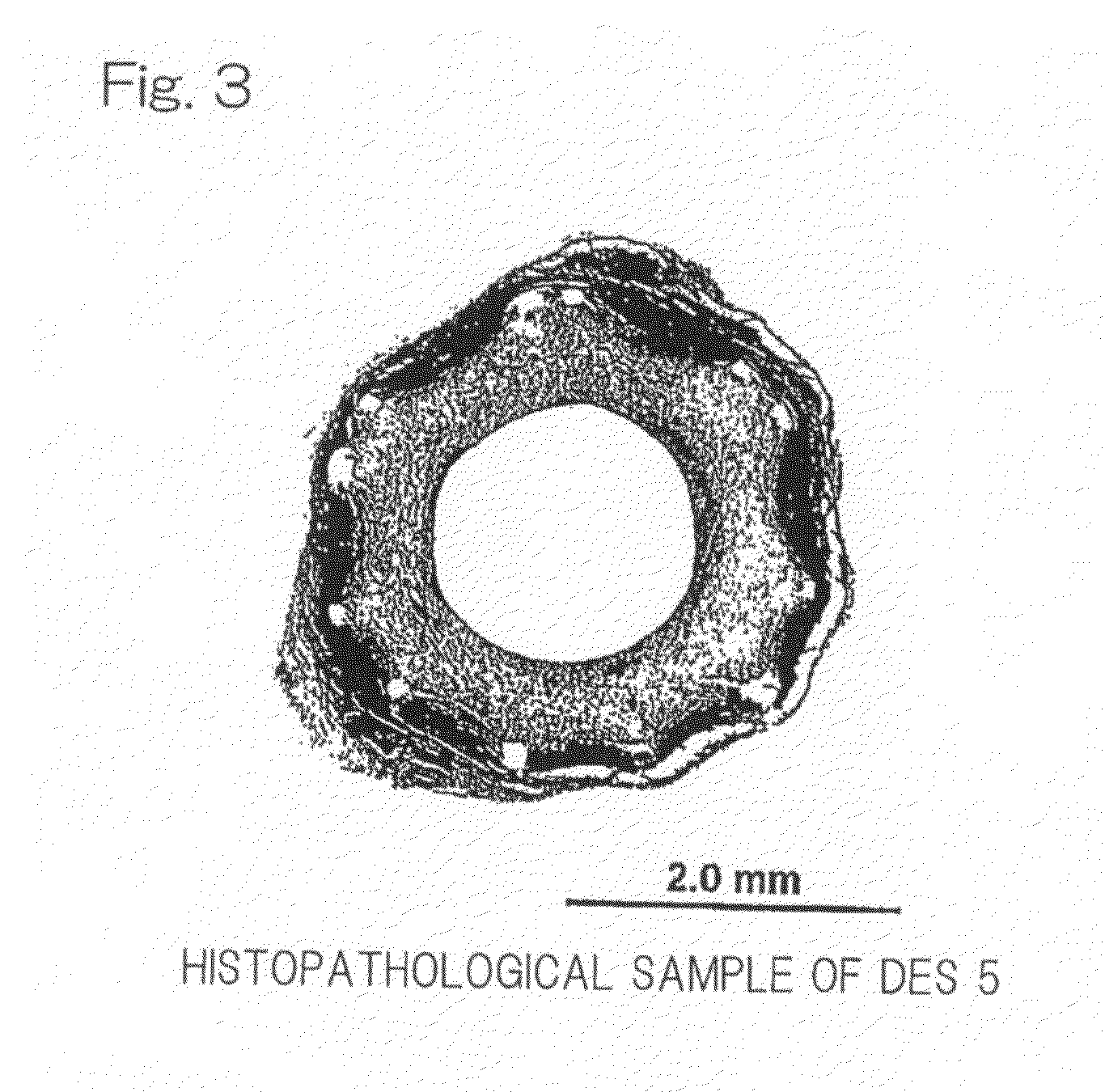 Sustained drug-releasing stent