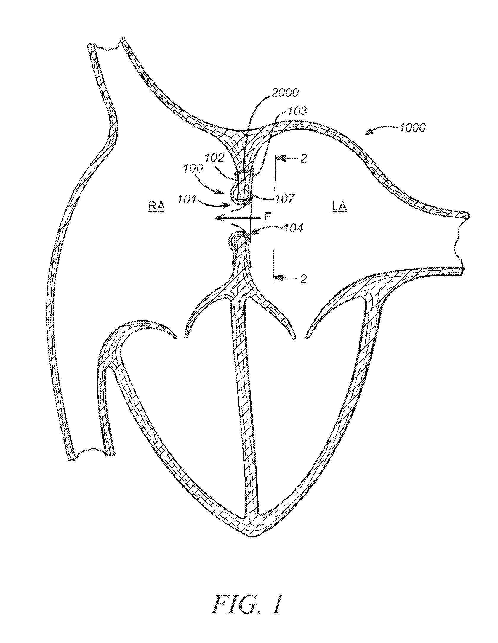 Mounting tool for loading a prosthesis