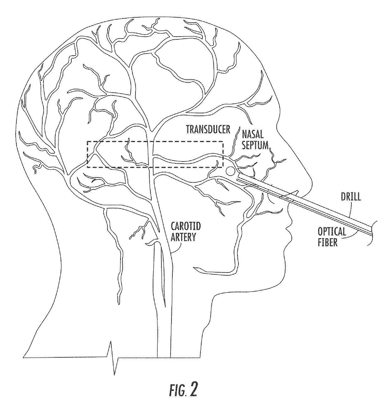 Method and system for transcranial photoacoustic imaging for guiding skull base surgeries