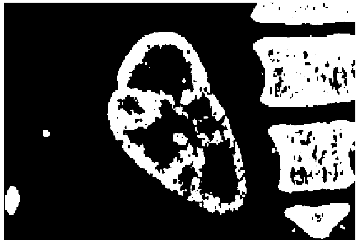 A Localization Method of Renal Cortex Based on Statistical Shape Model